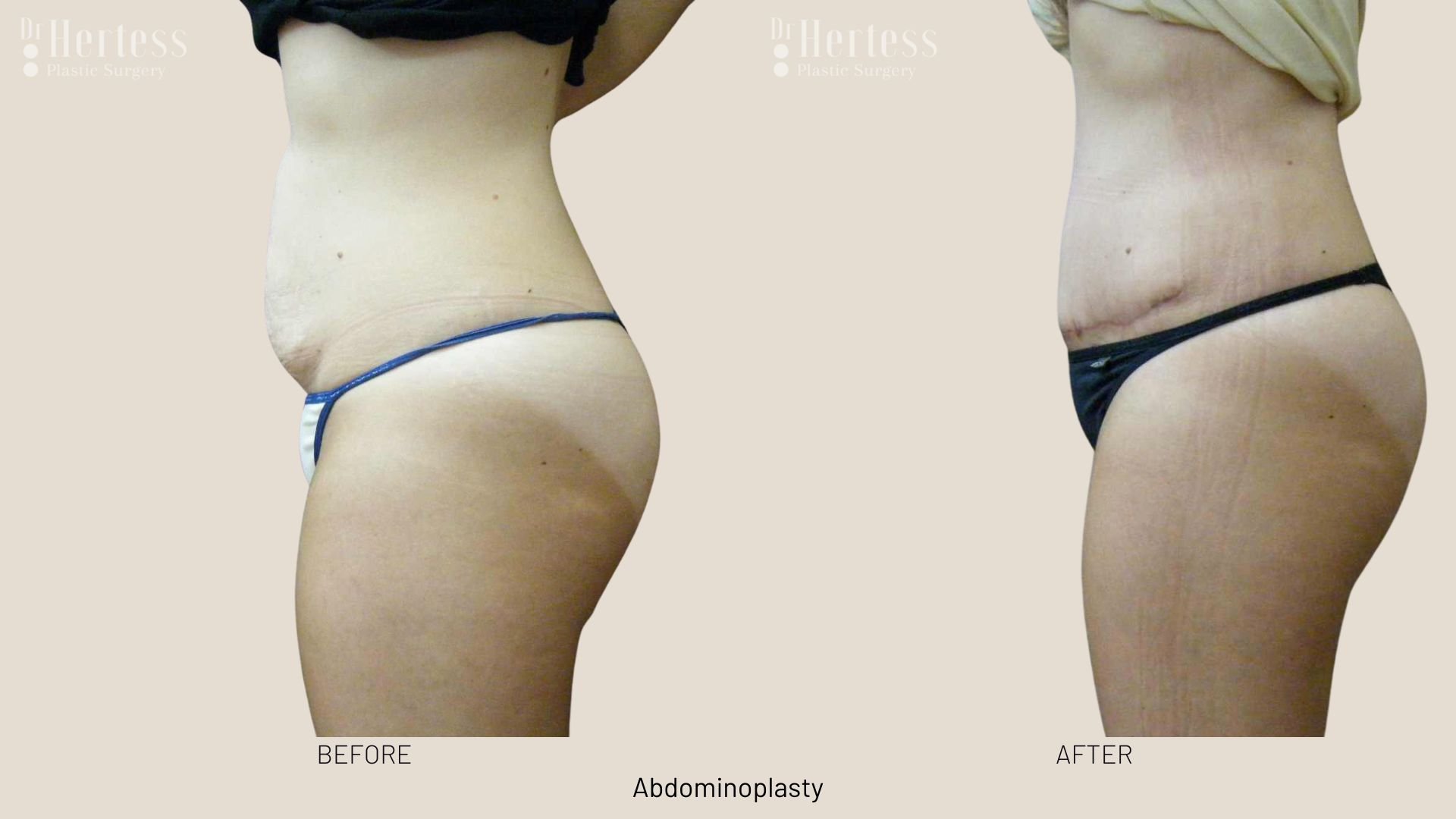 abdominoplasty before after