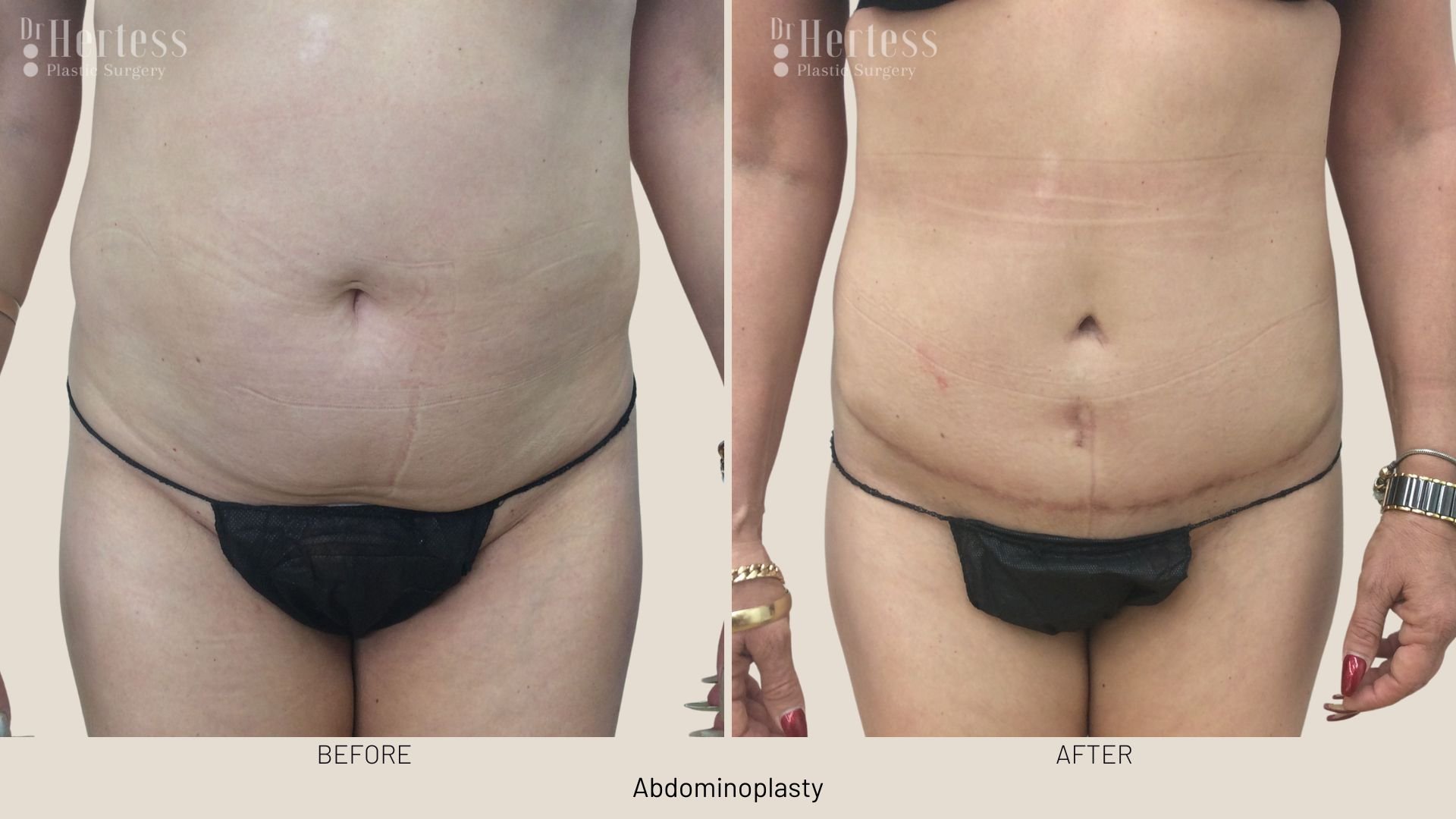 abdominoplasty before after