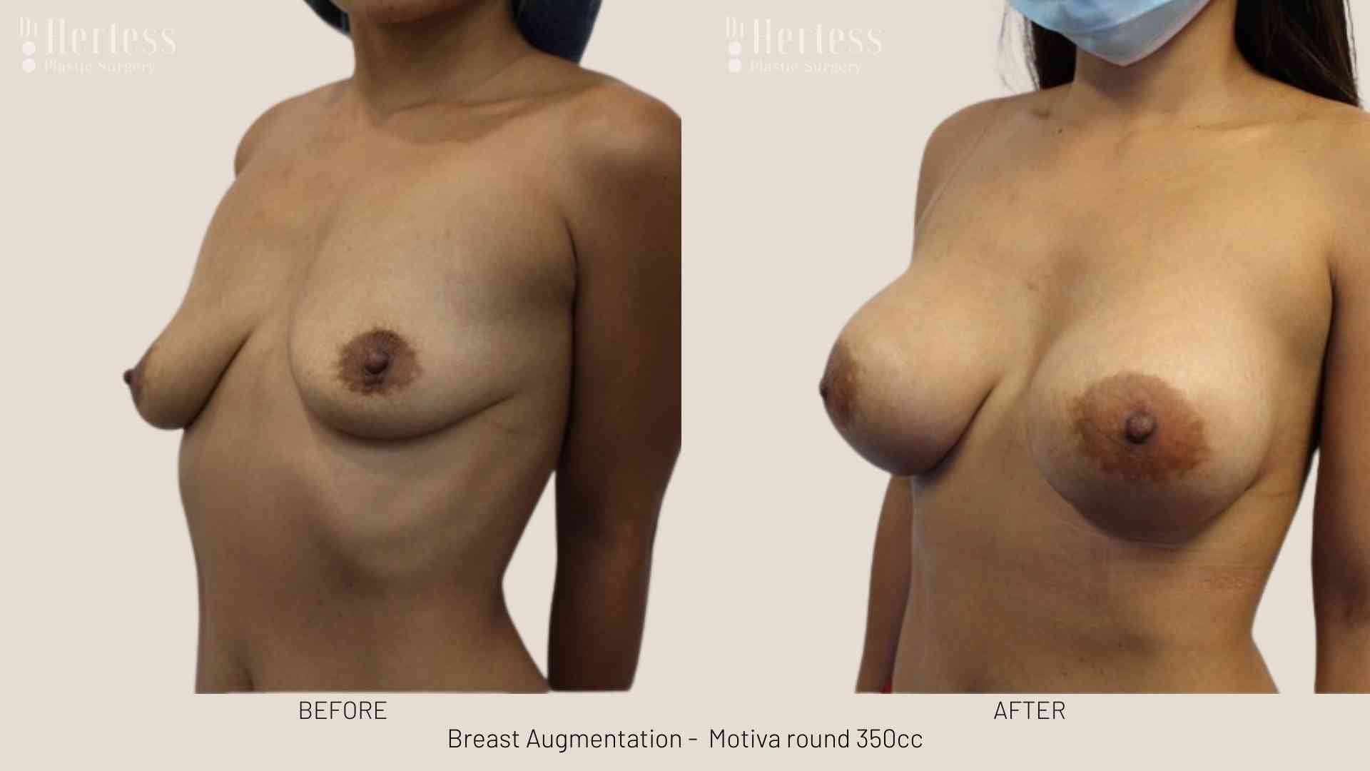 breast implant pictures