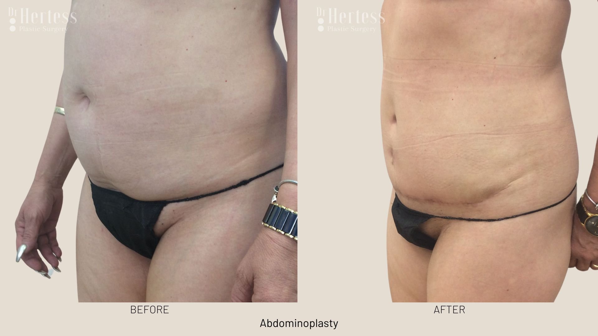 abdominoplasty before after