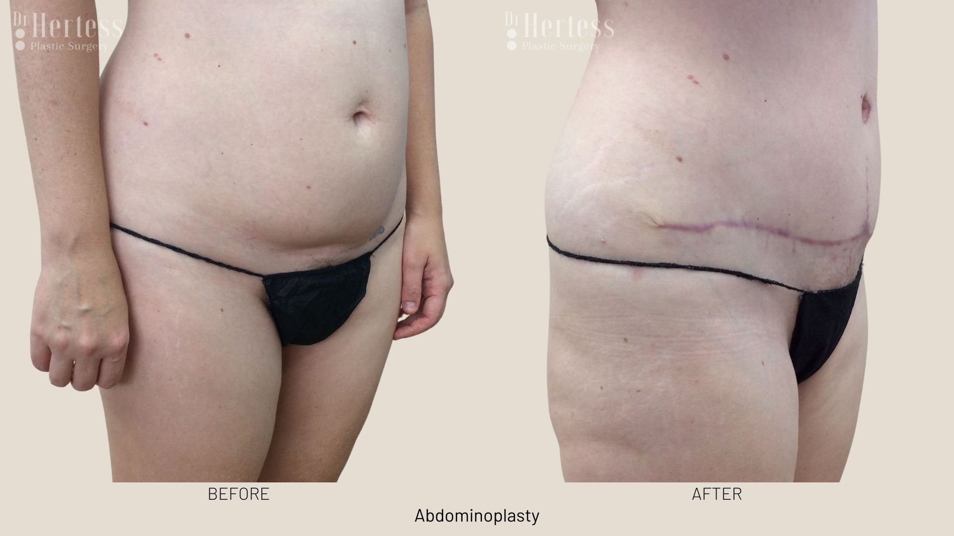 tummy tuck surgery before after