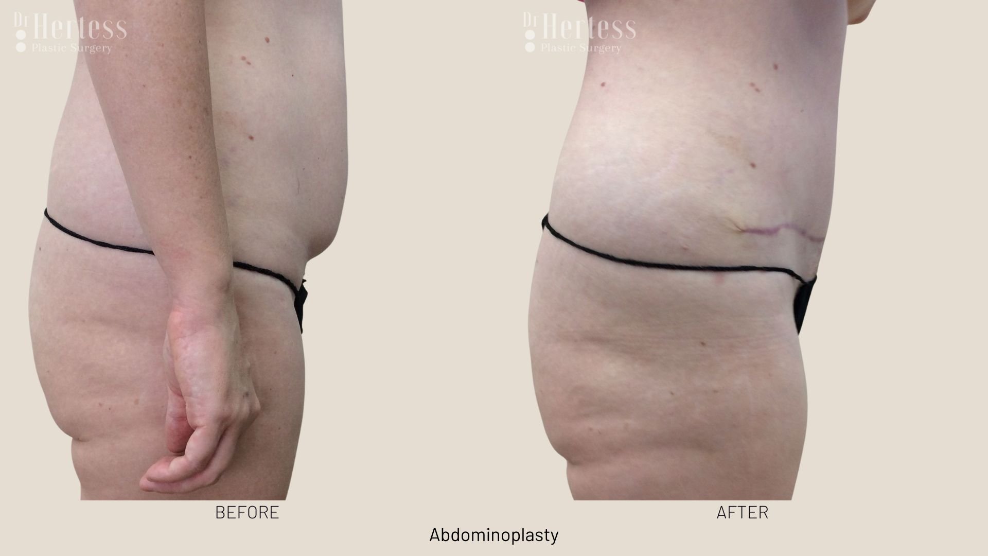 tummy tuck surgery before after