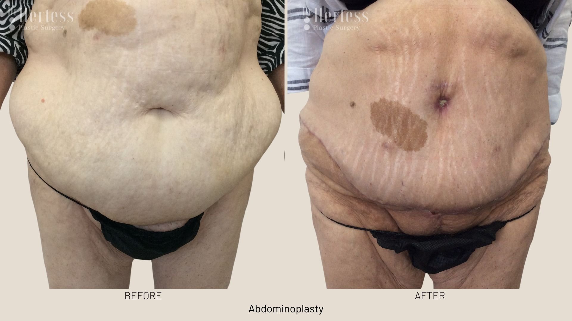 tummy tuck surgery before after