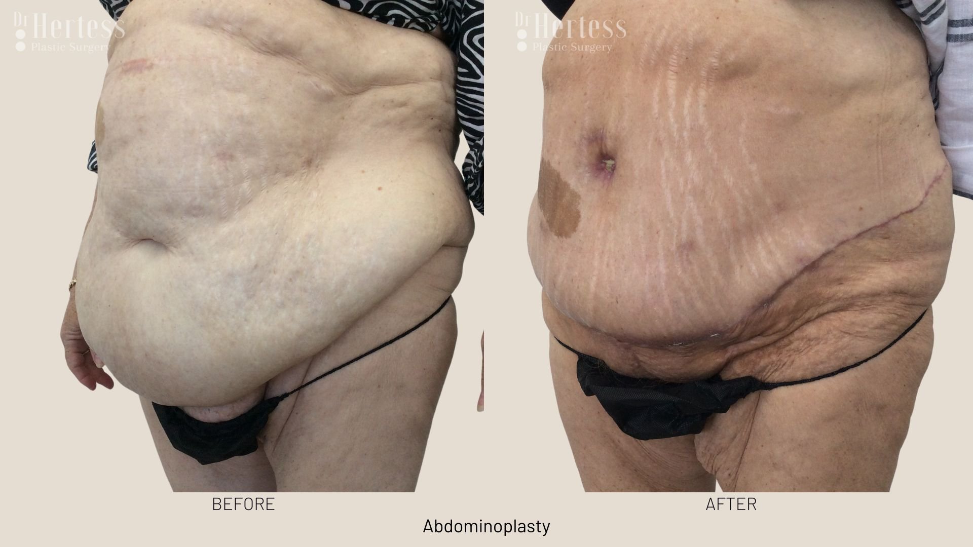 tummy tuck surgery before after