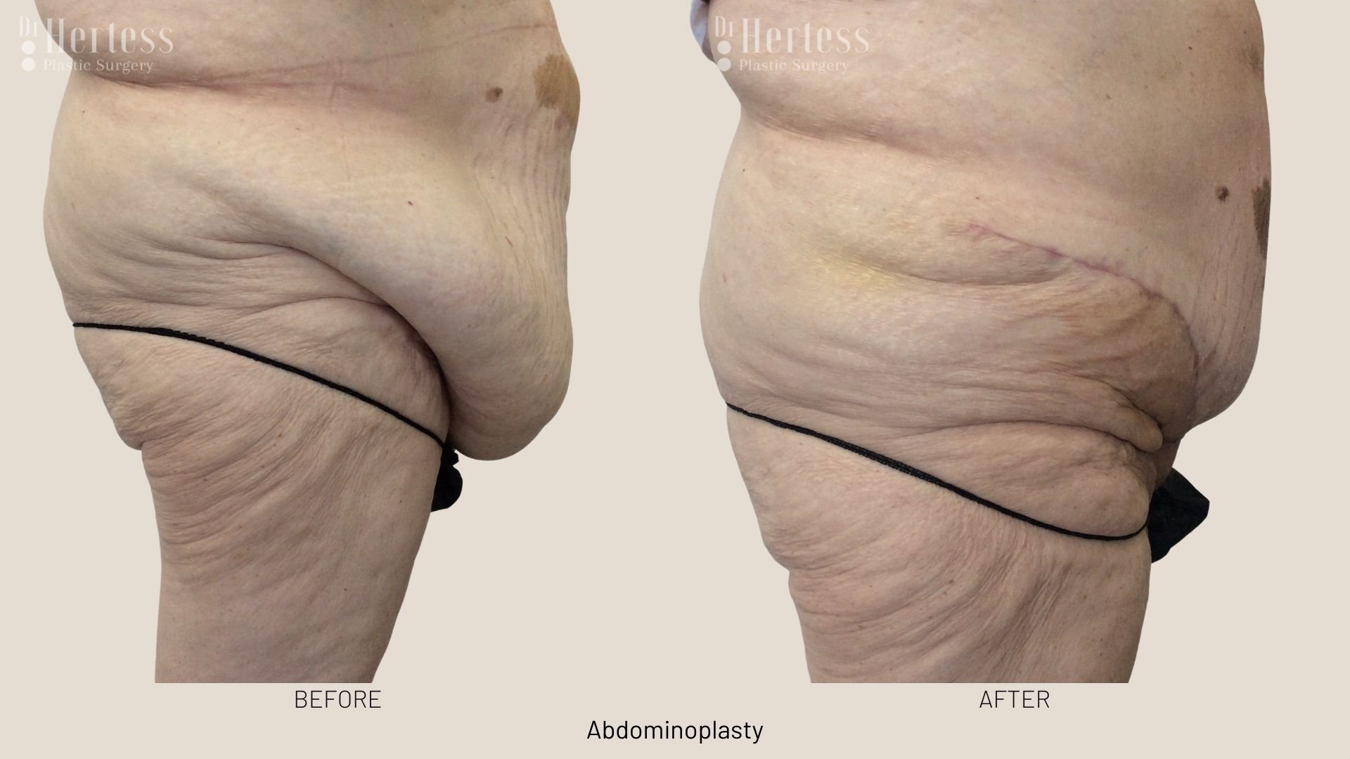 tummy tuck surgery before after