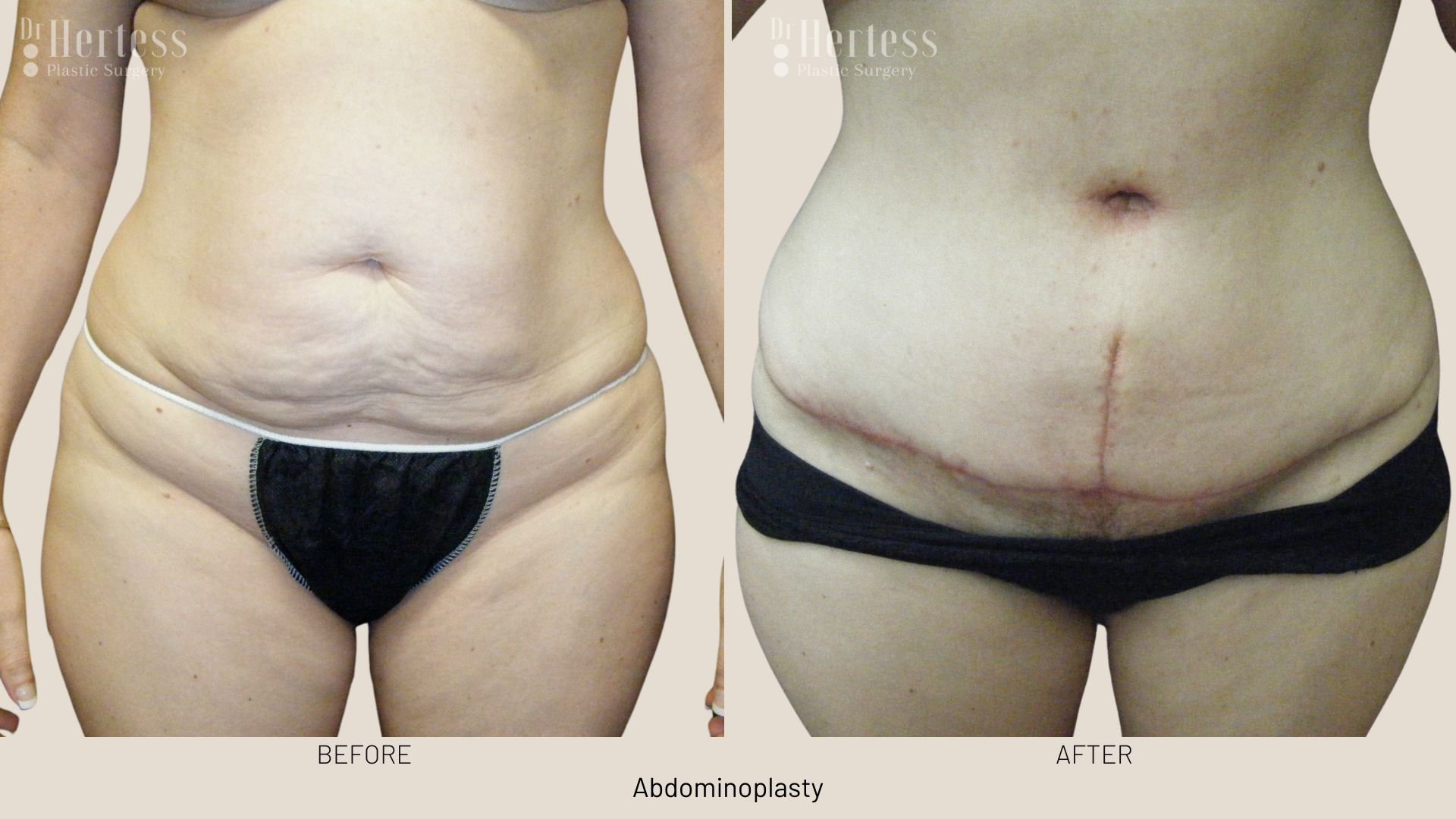 tummy tuck surgery before after