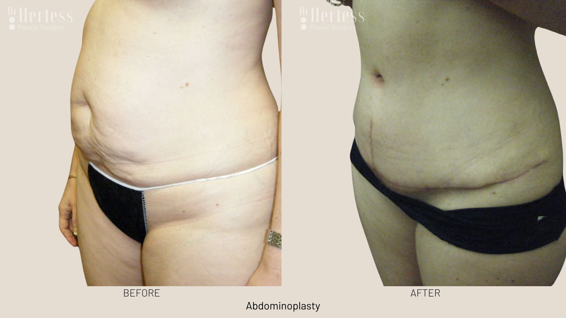 tummy tuck surgery before after