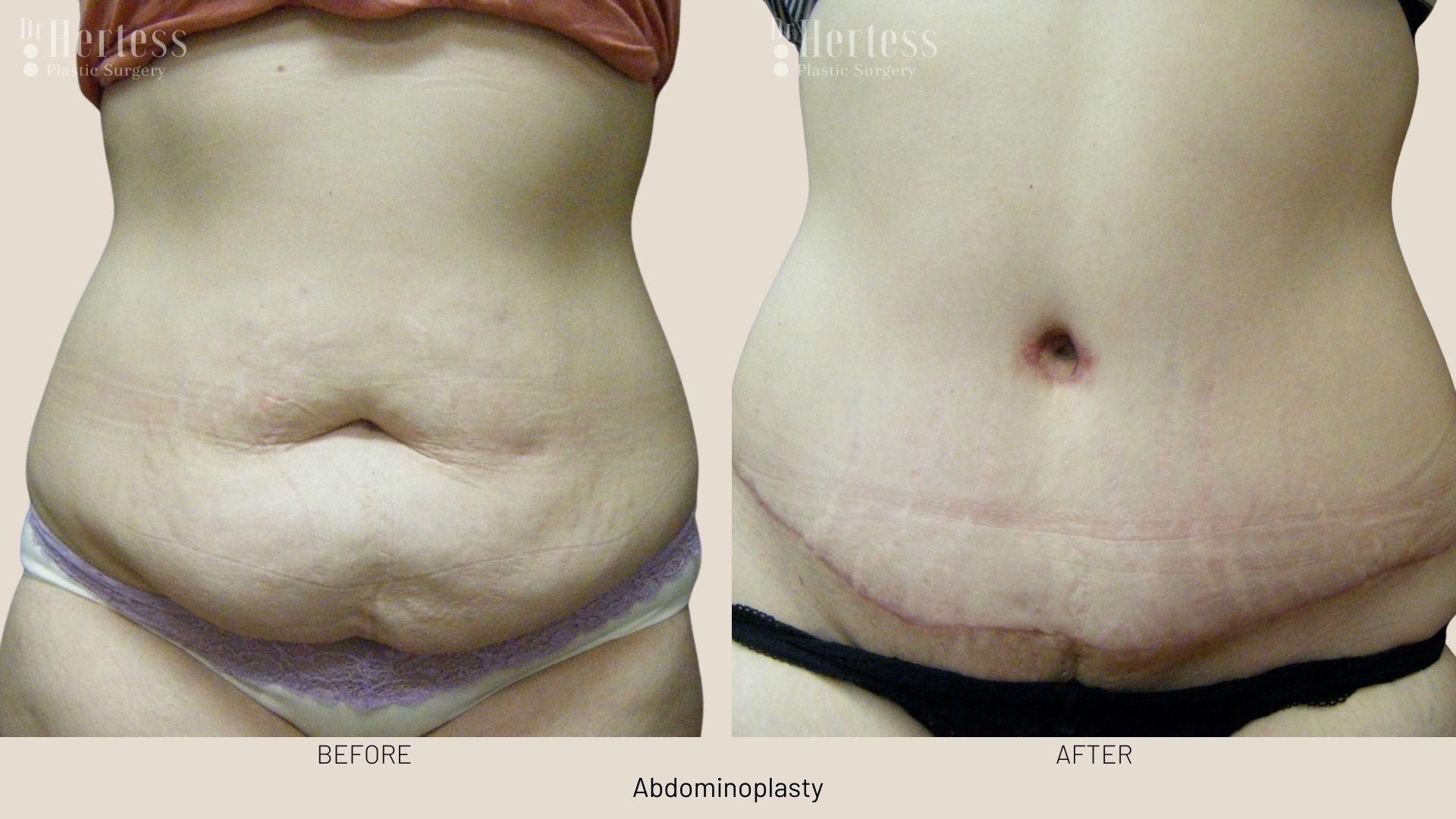 tummy tuck surgery before after