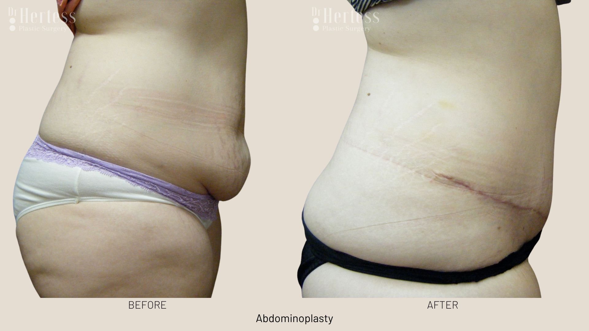 tummy tuck surgery before after