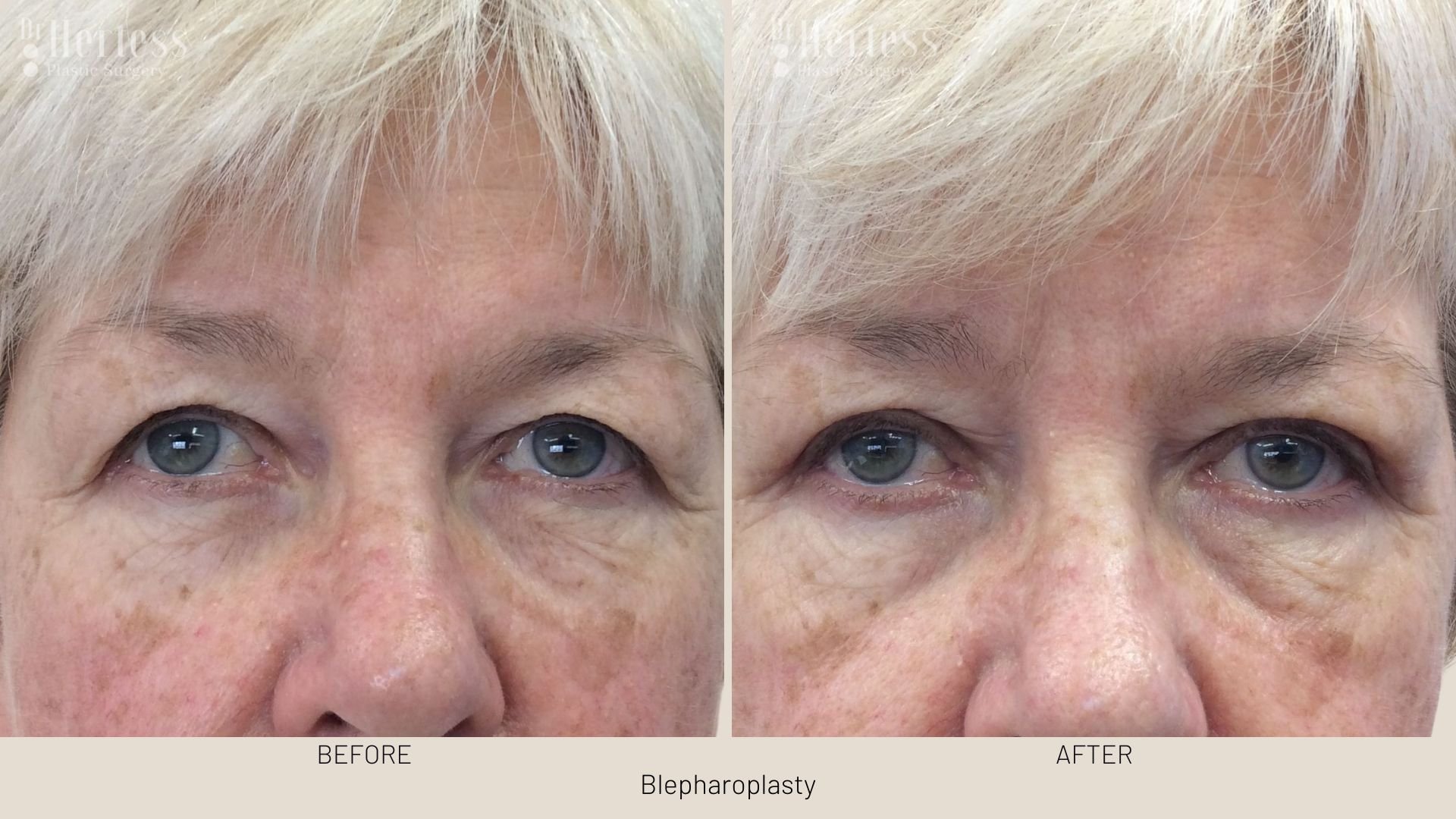 eye lift before and after