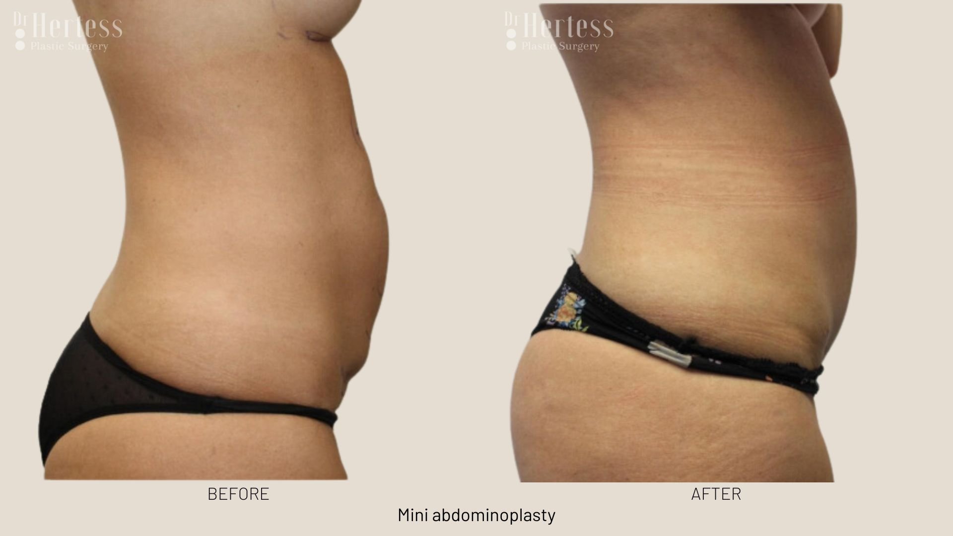 abdominoplasty before and after