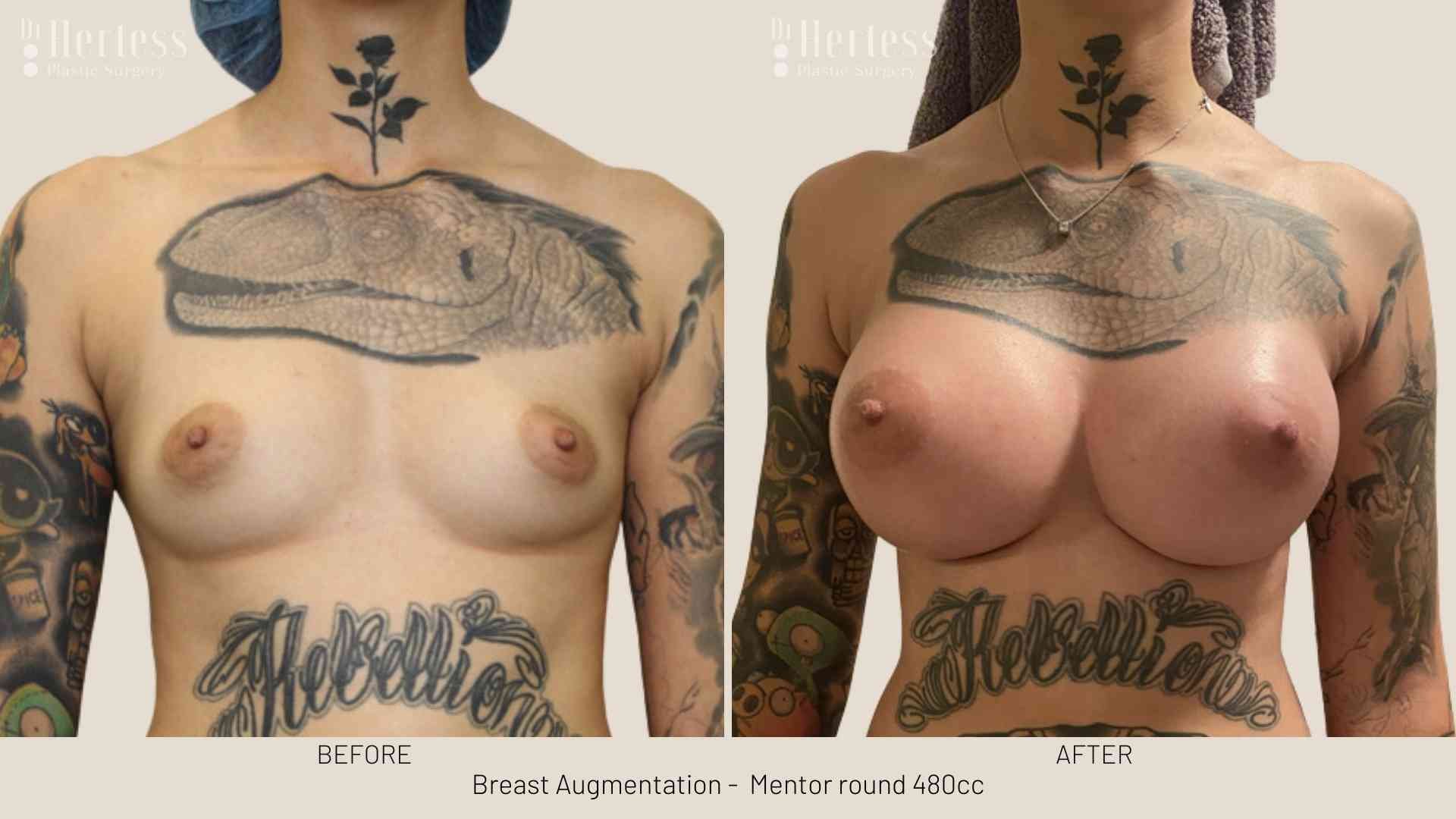 breast implants before and after pictures