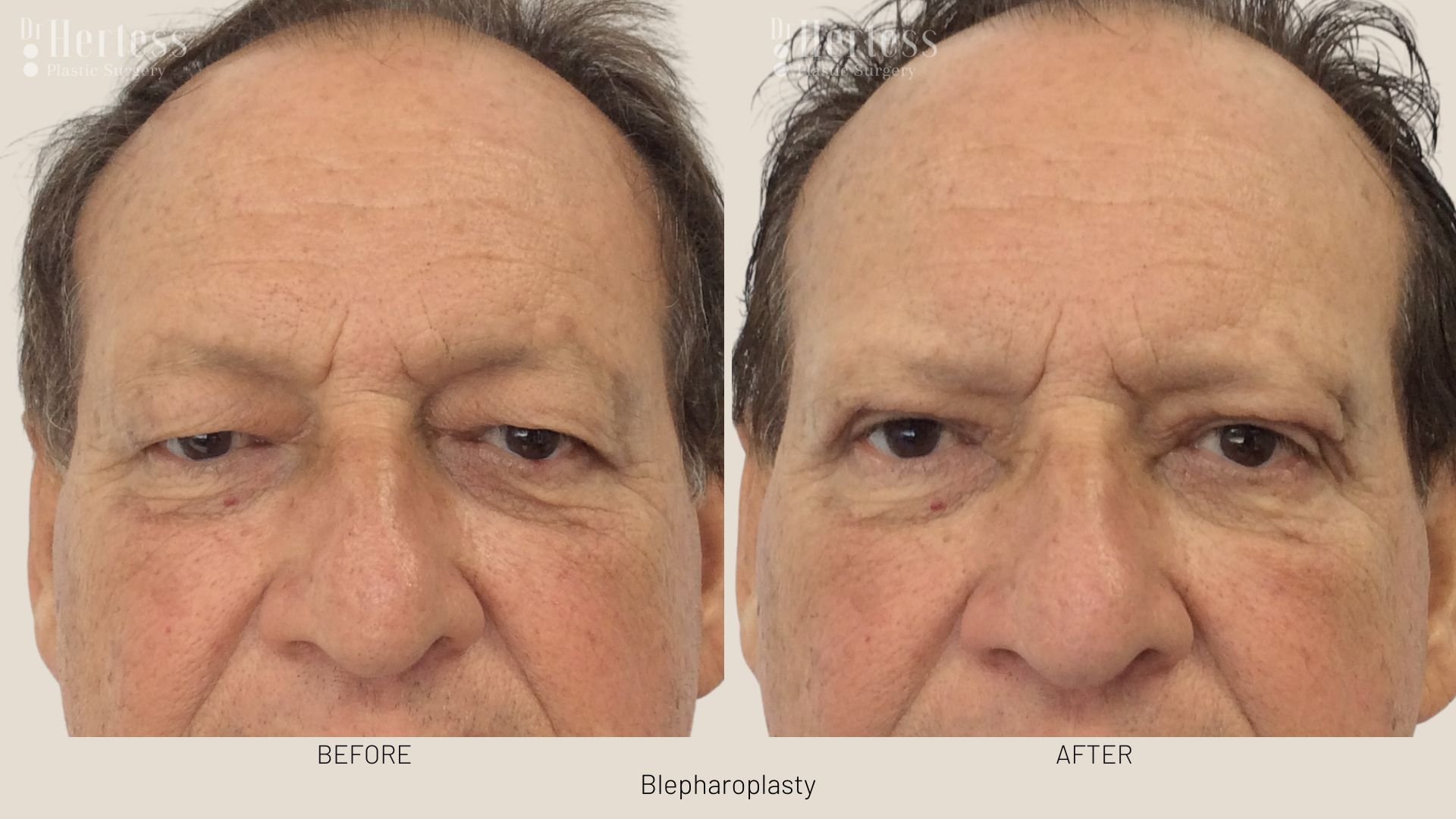 blepharoplasty surgery before and after