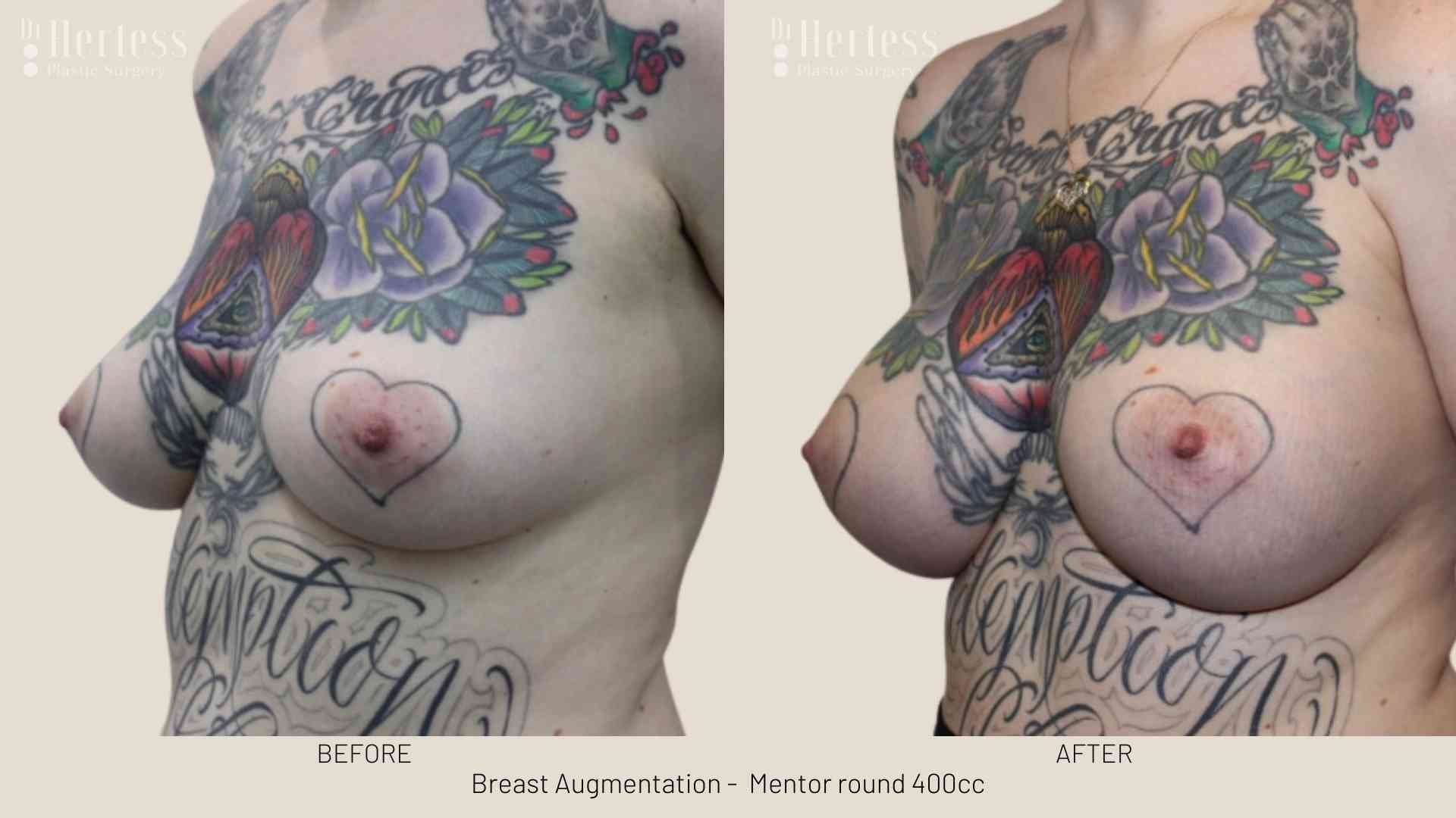 breast implants before and after pictures