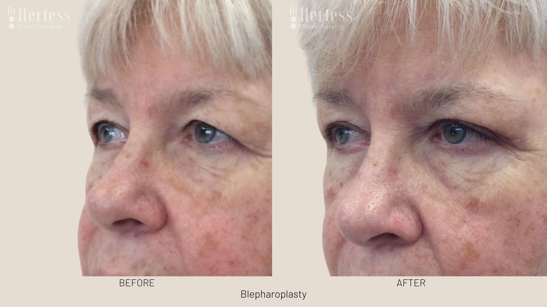 blepharoplasty surgery before and after
