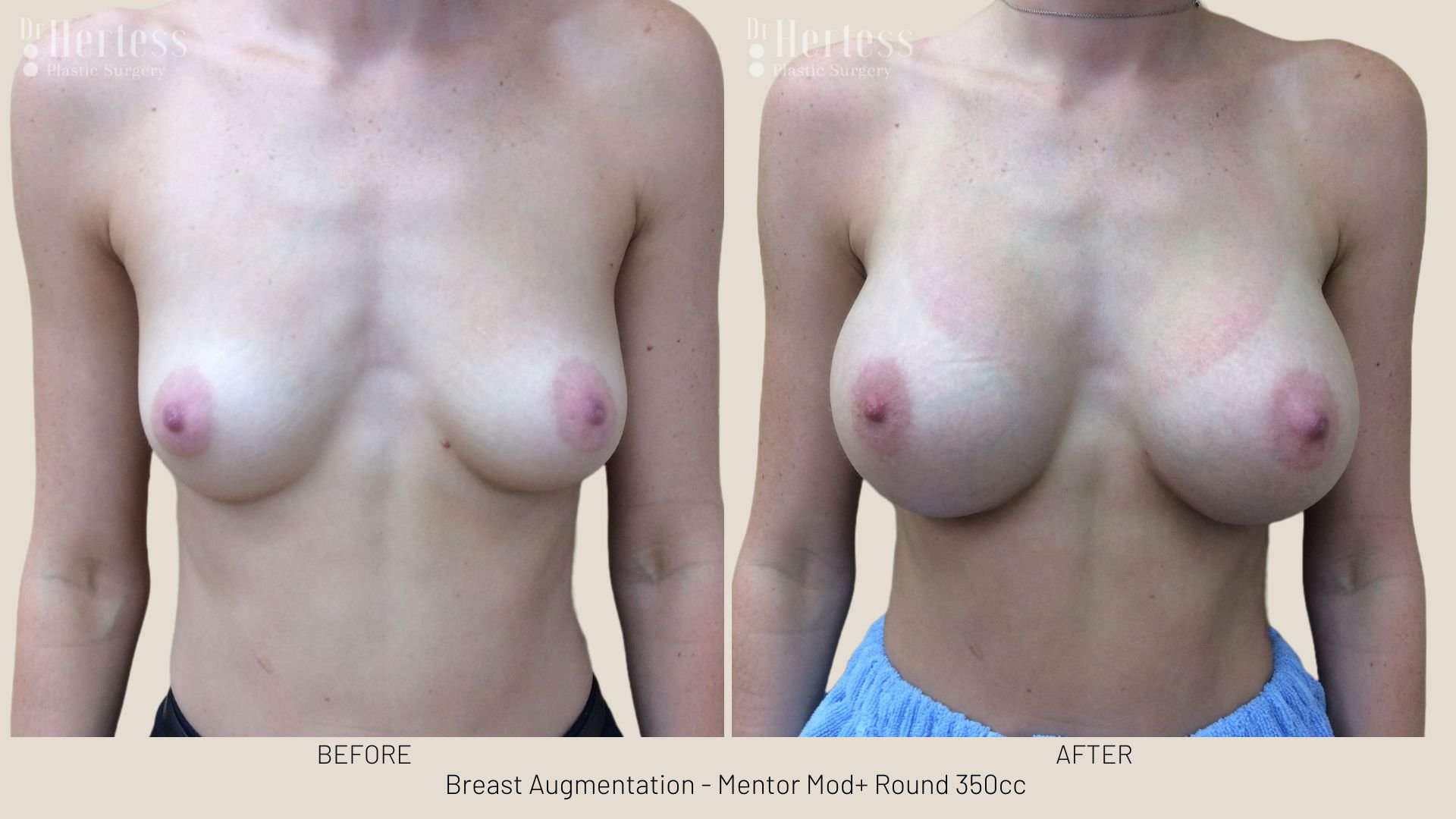 breast augmentation pics gold coast