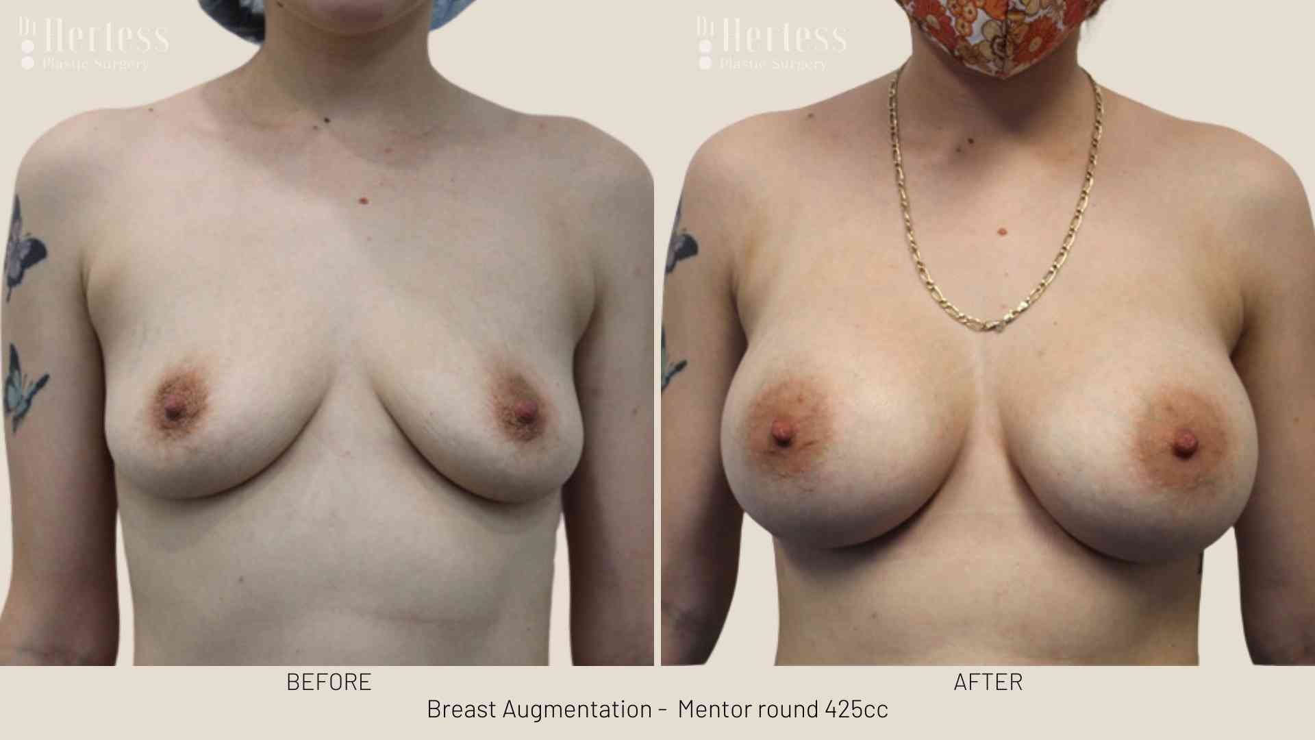 breast implants before and after pictures