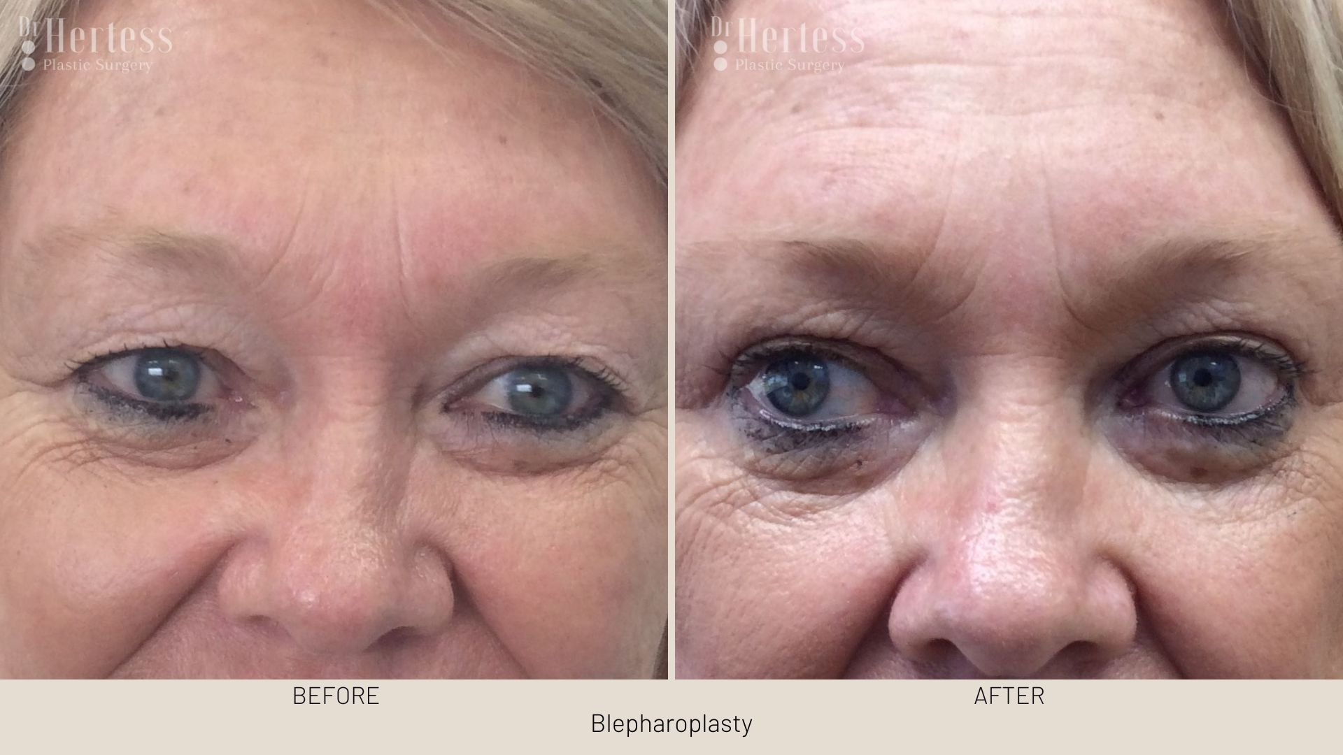 blepharoplasty surgery before and after