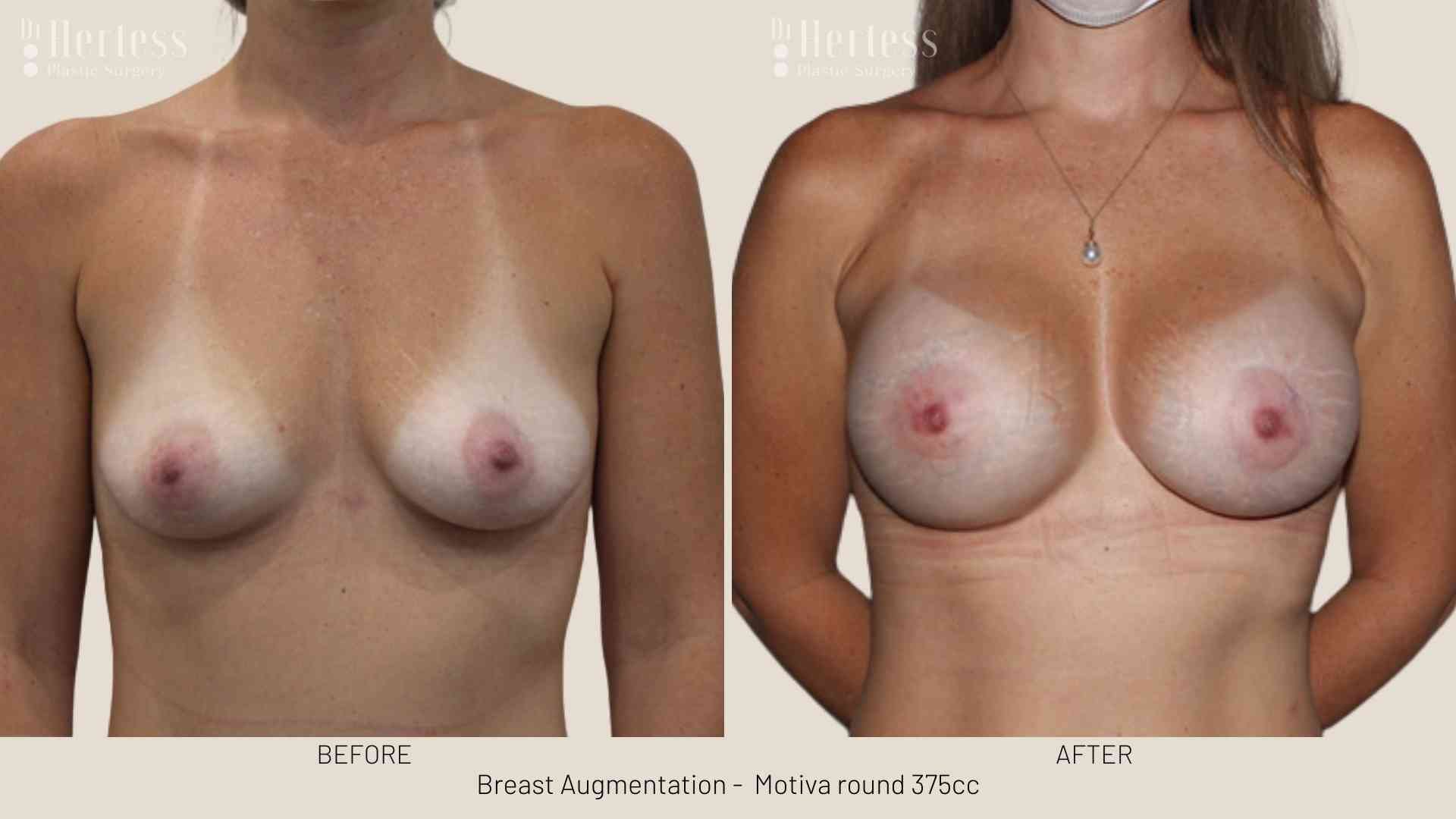 breast implants before and after pictures
