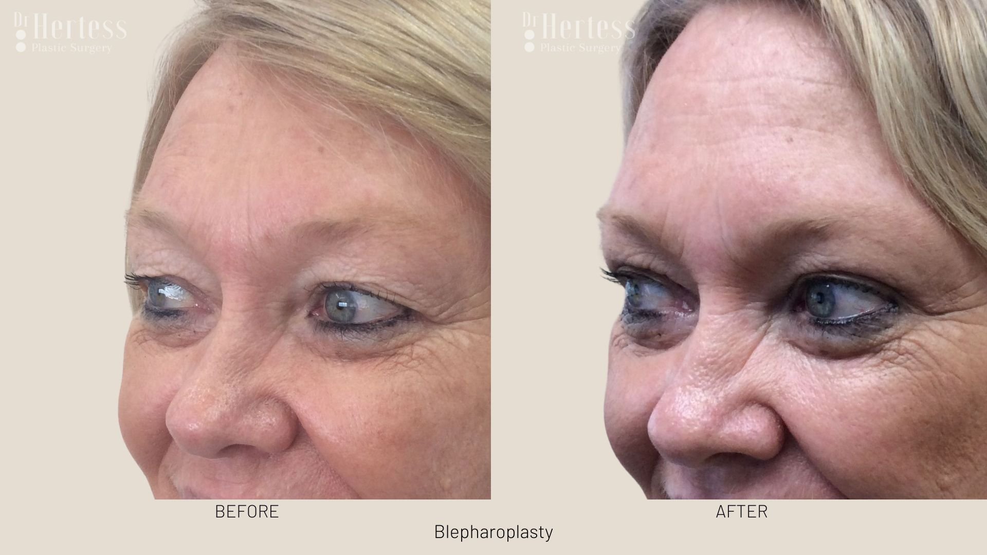 blepharoplasty surgery before and after