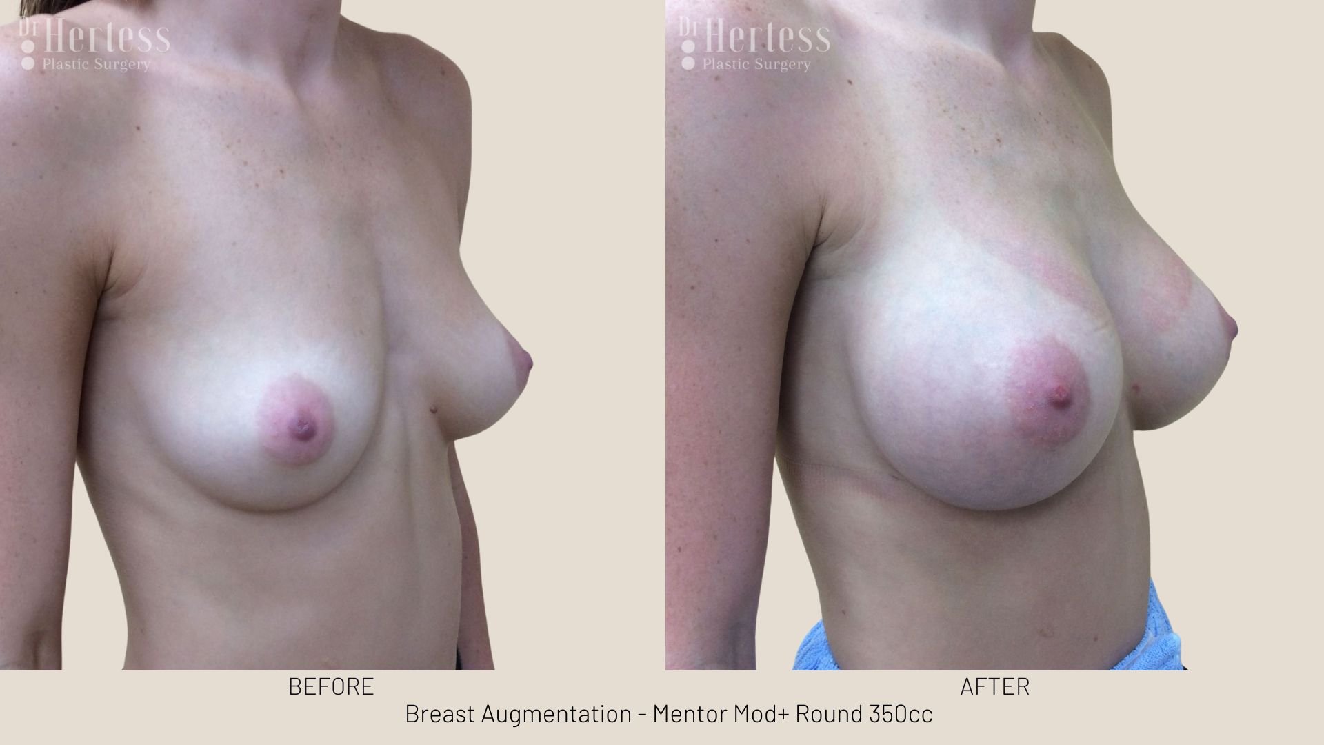 breast augmentation pics gold coast