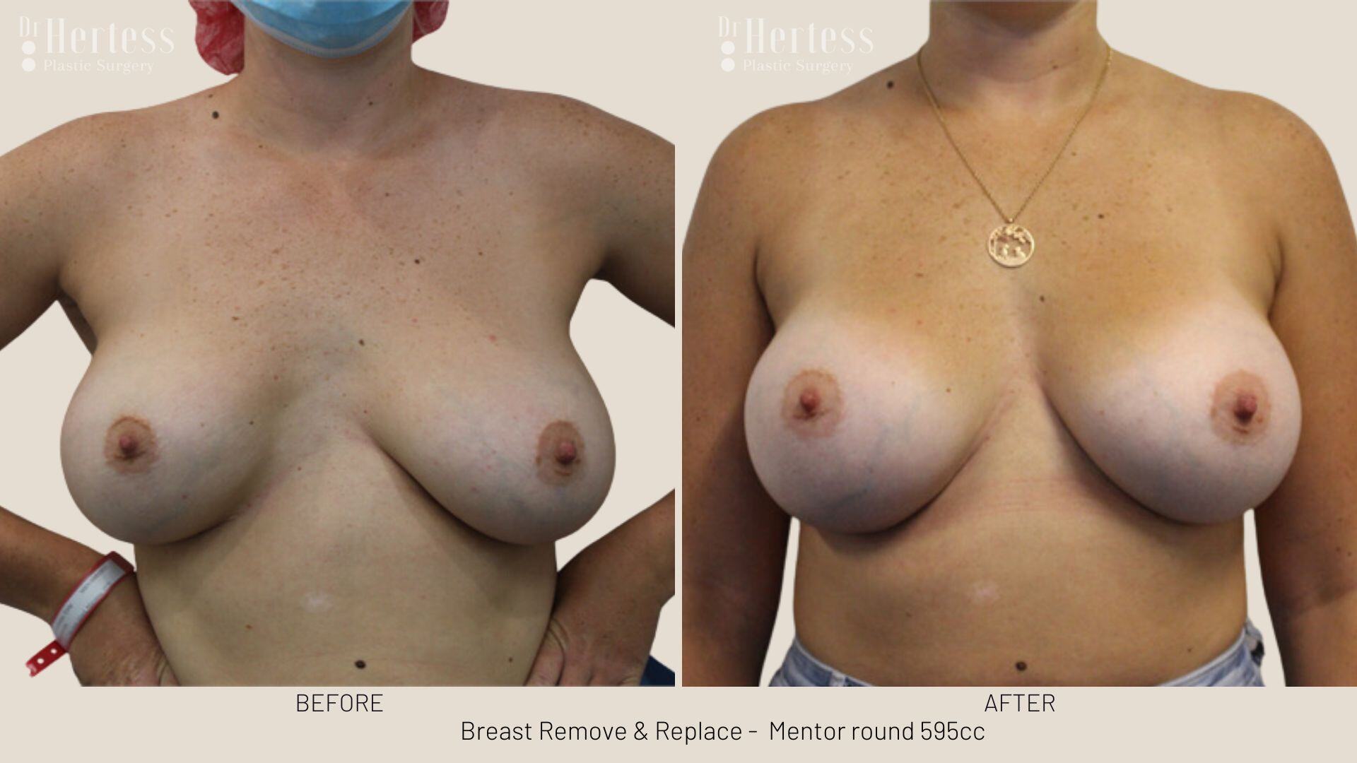 breast implant replacement photos
