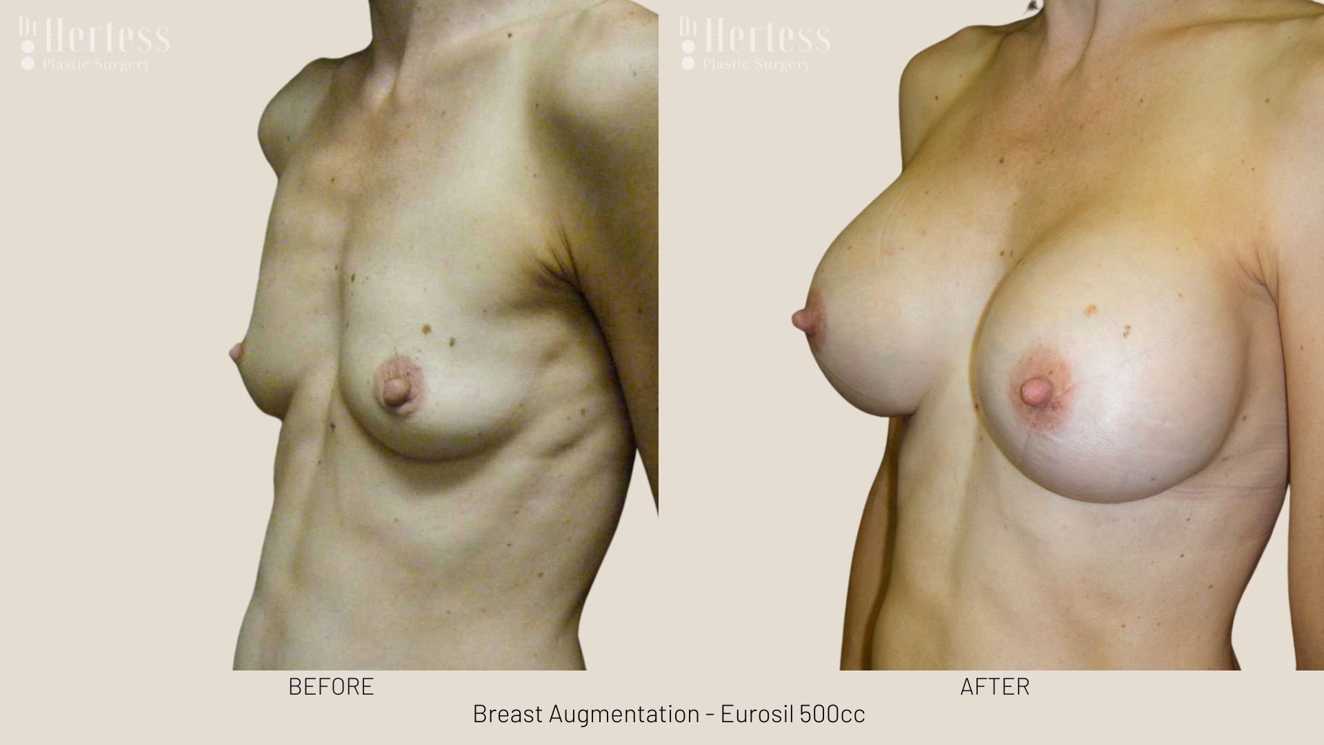 breast implants before and after