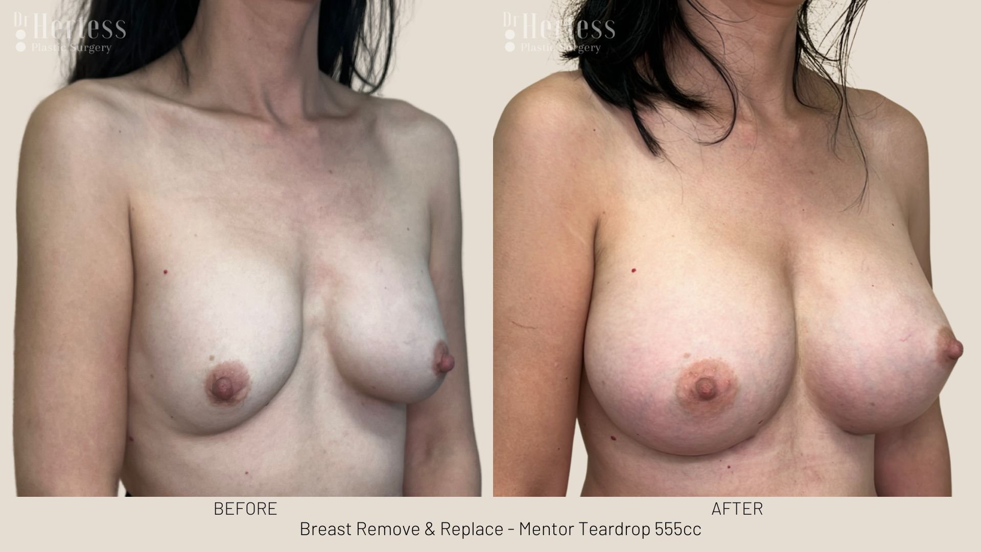 breast implant removal and replacement