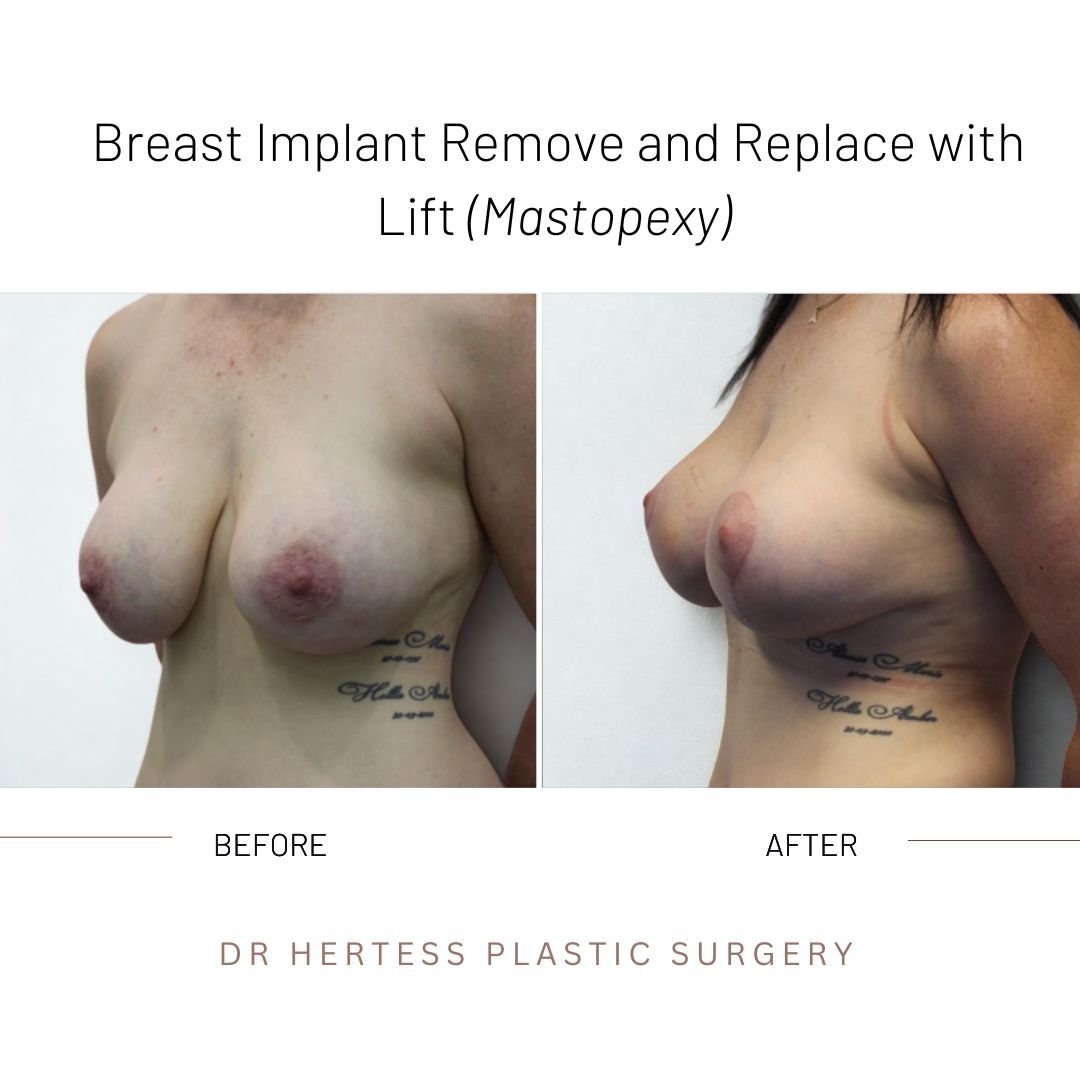 before and after breasts