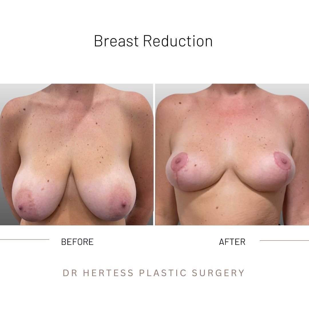 before and after breast reduction