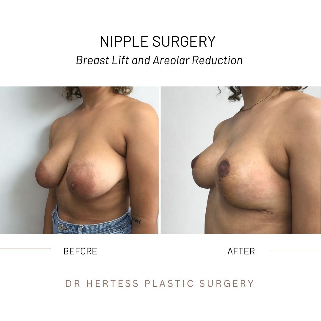 before and after nipple surgery