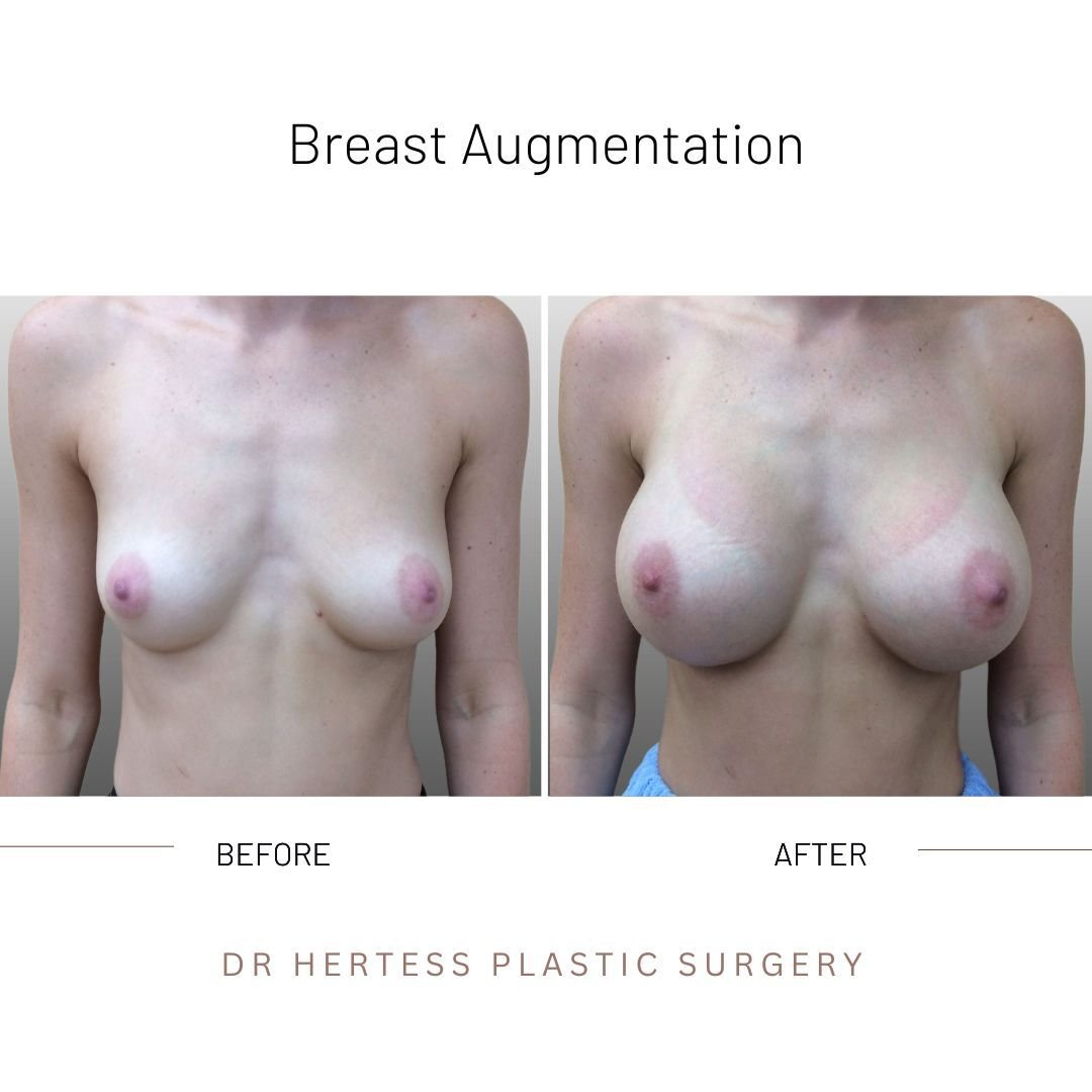 boob job before and after