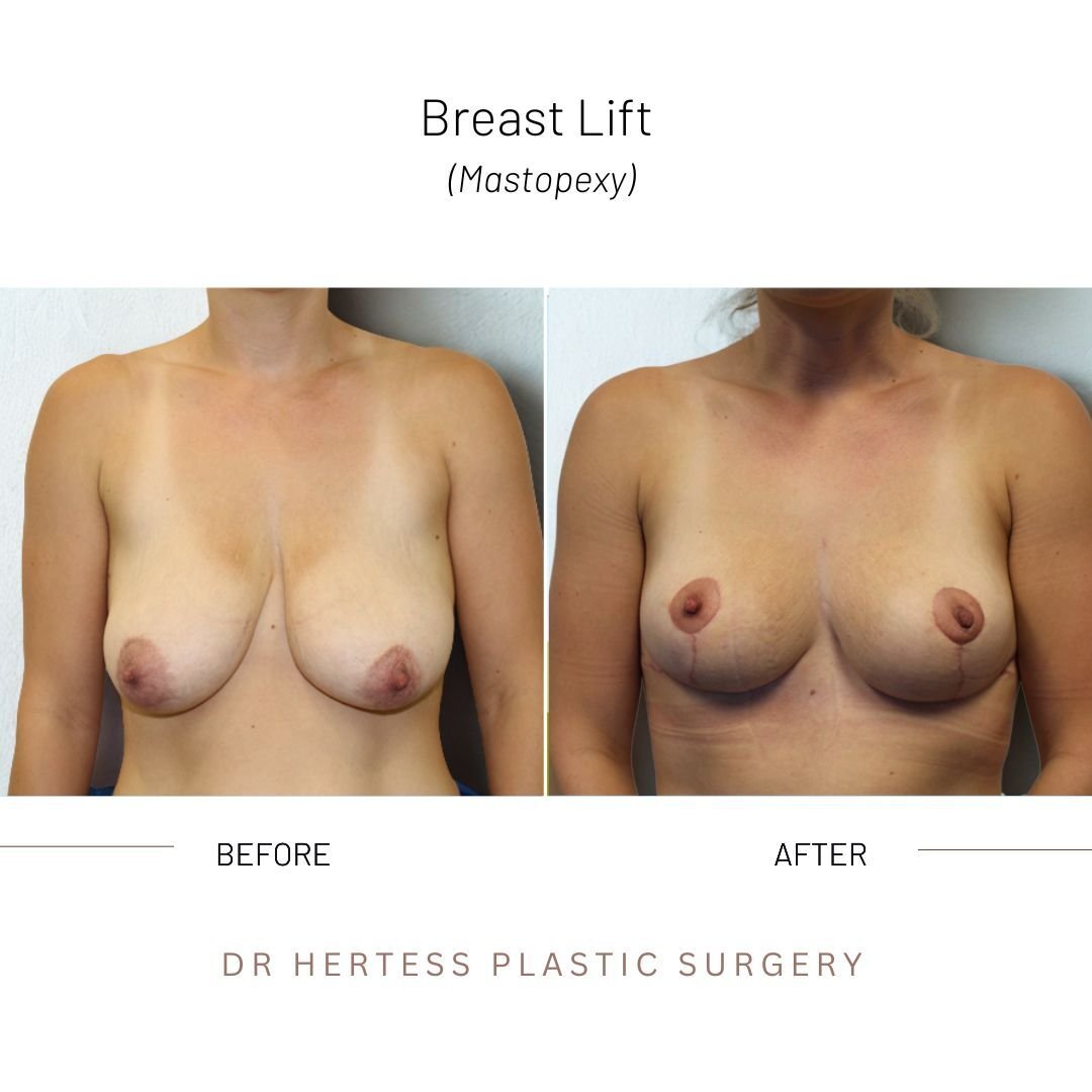 breast lift before and after