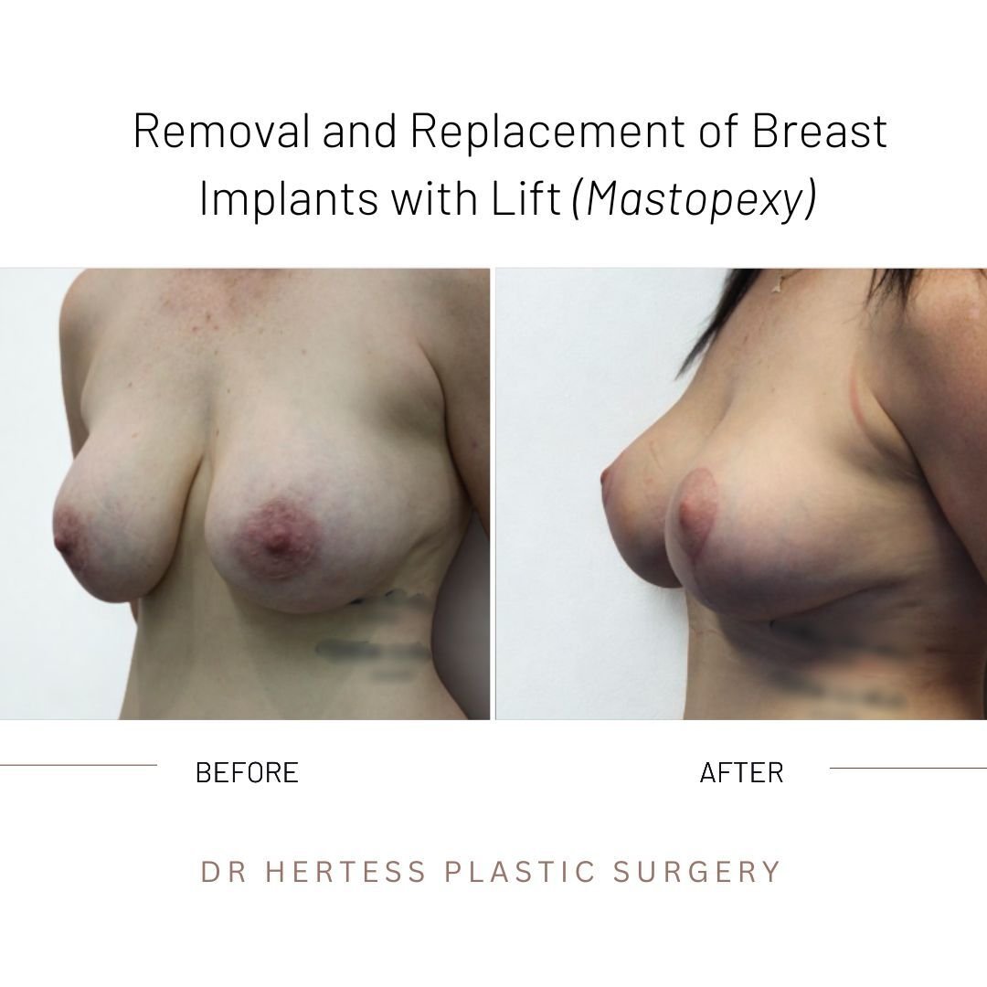 breast remove and replace before and after