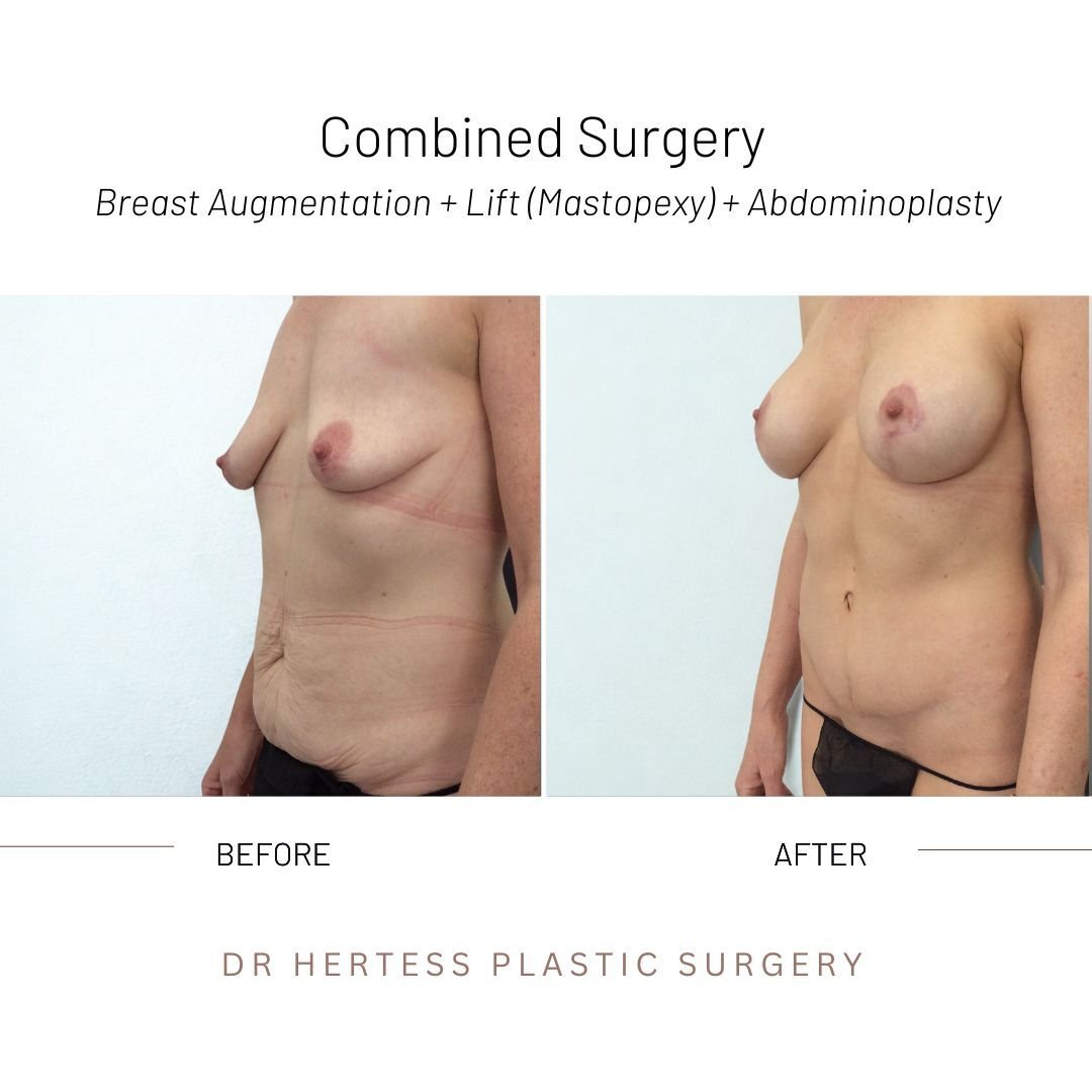 Mummy makeover before after