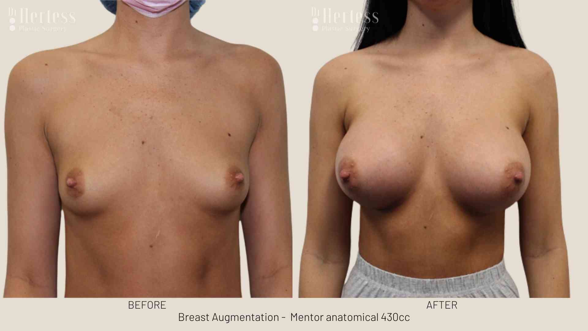 breast implants before and after pictures