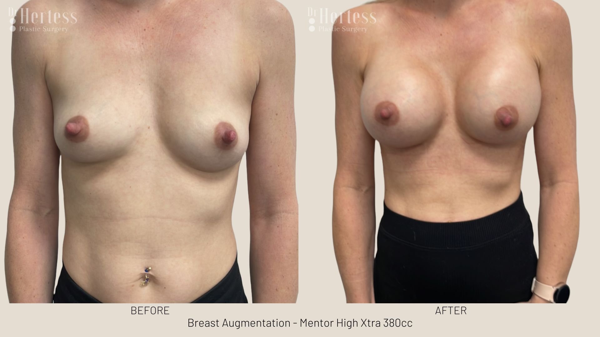 breast implant photos