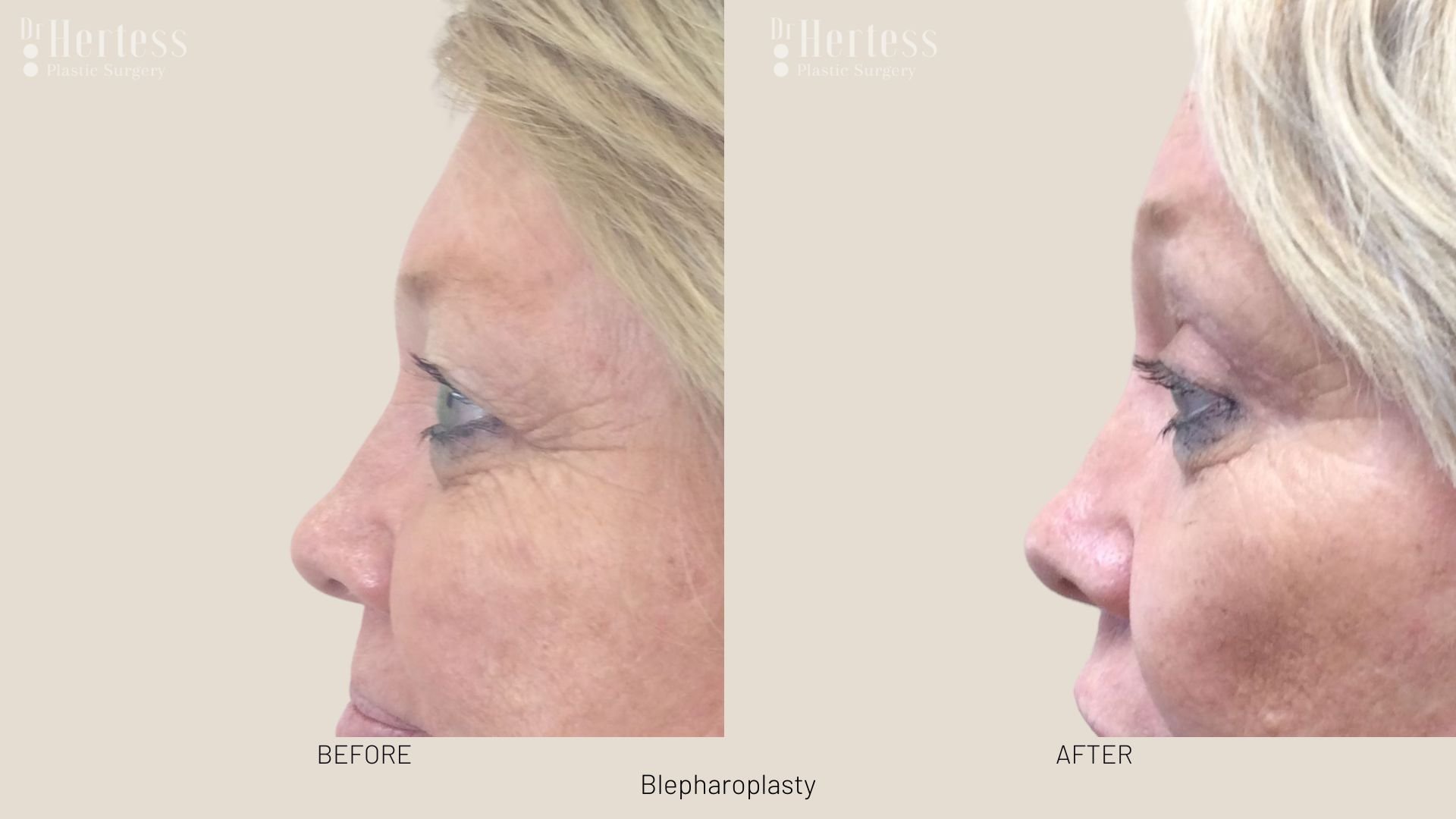 blepharoplasty surgery before and after