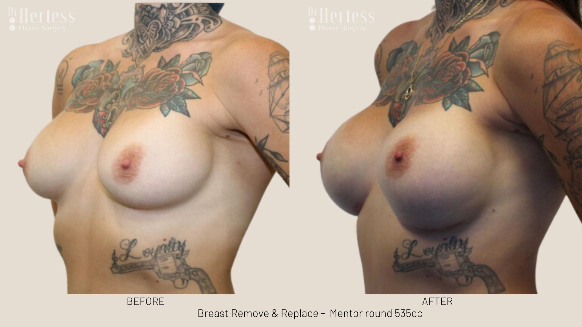 breast implant replacement photos
