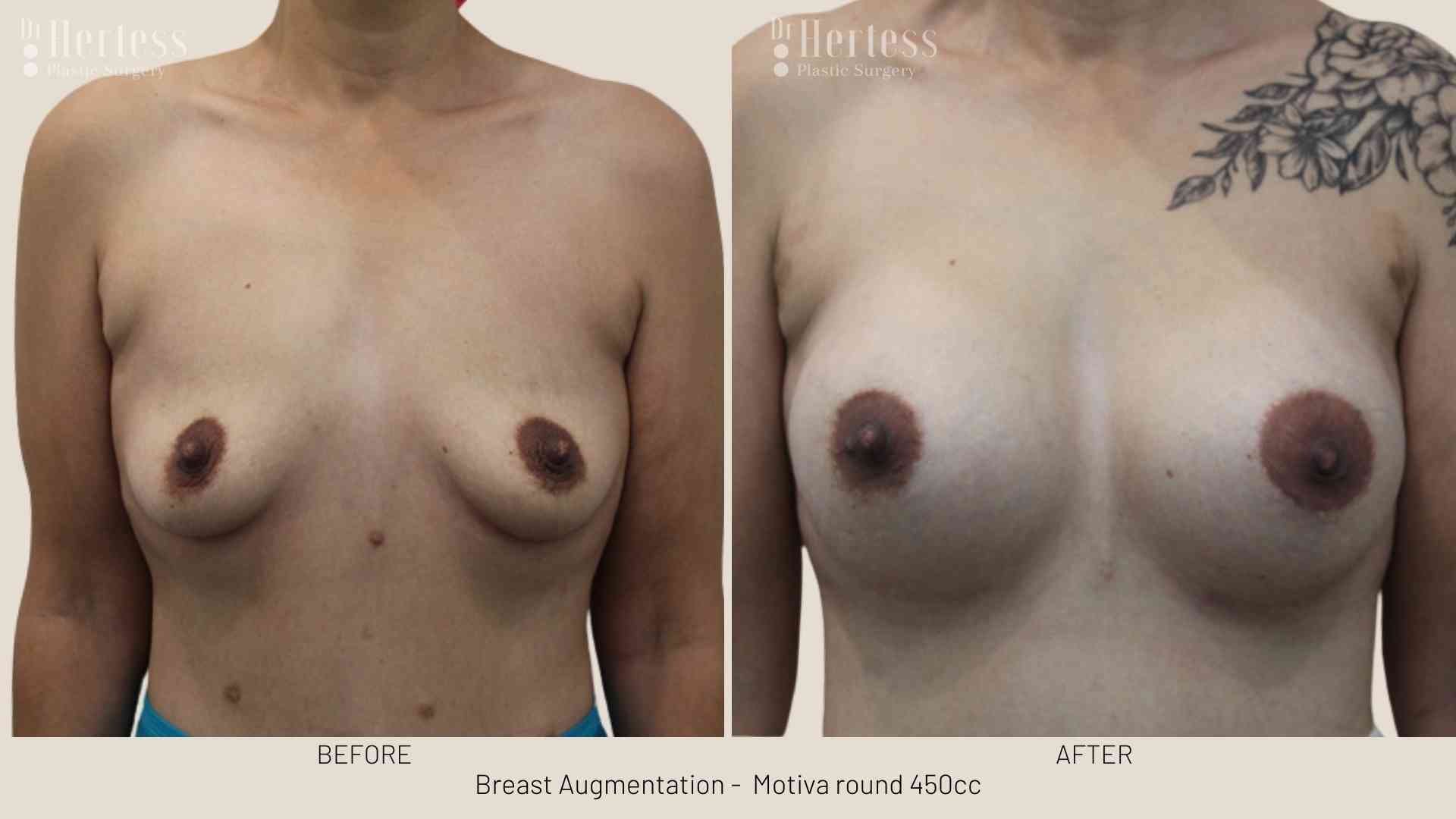 breast implants before and after pictures