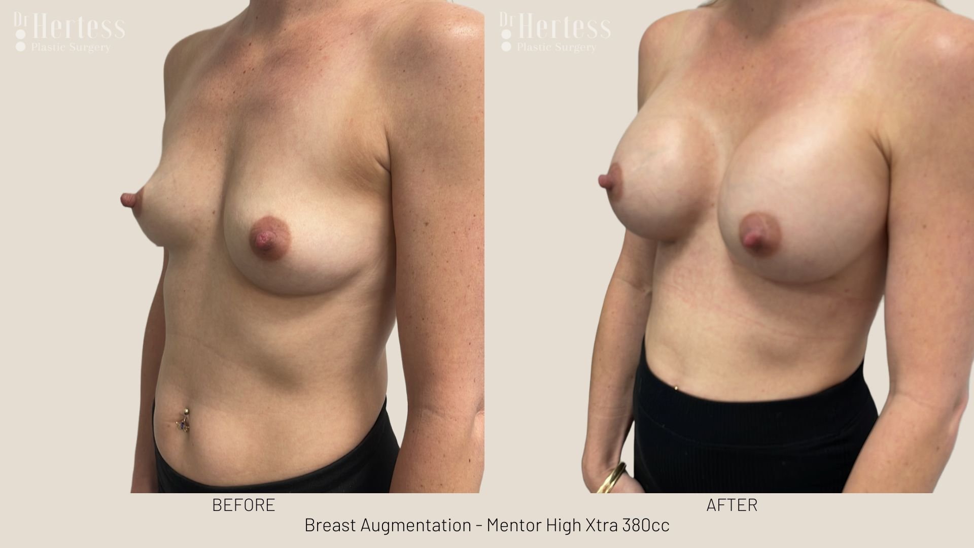 breast implant photos