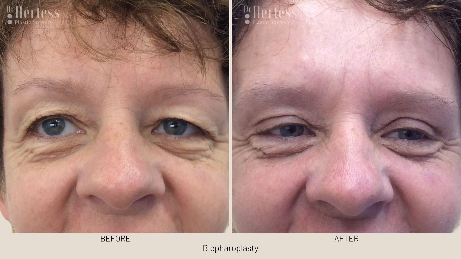 blepharoplasty surgery before and after