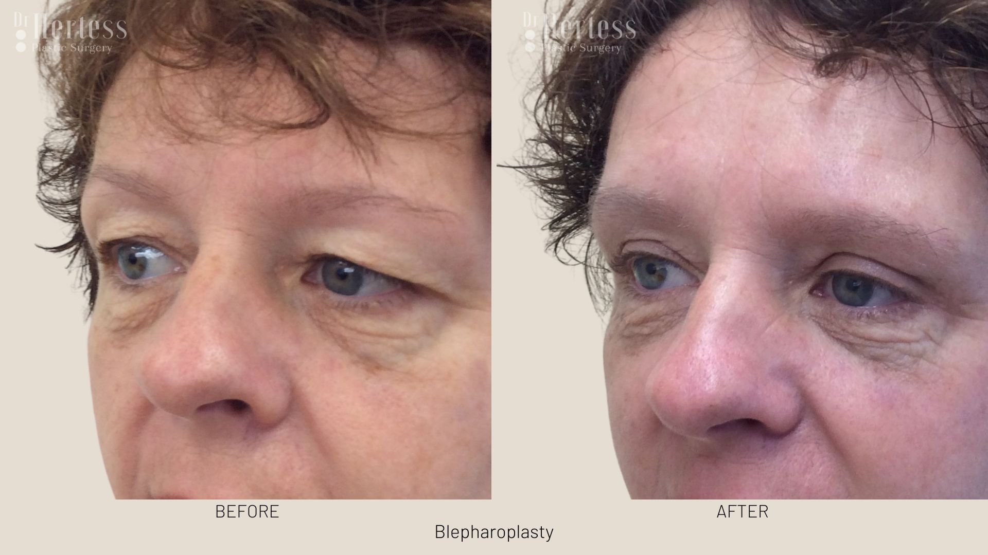 blepharoplasty surgery before and after