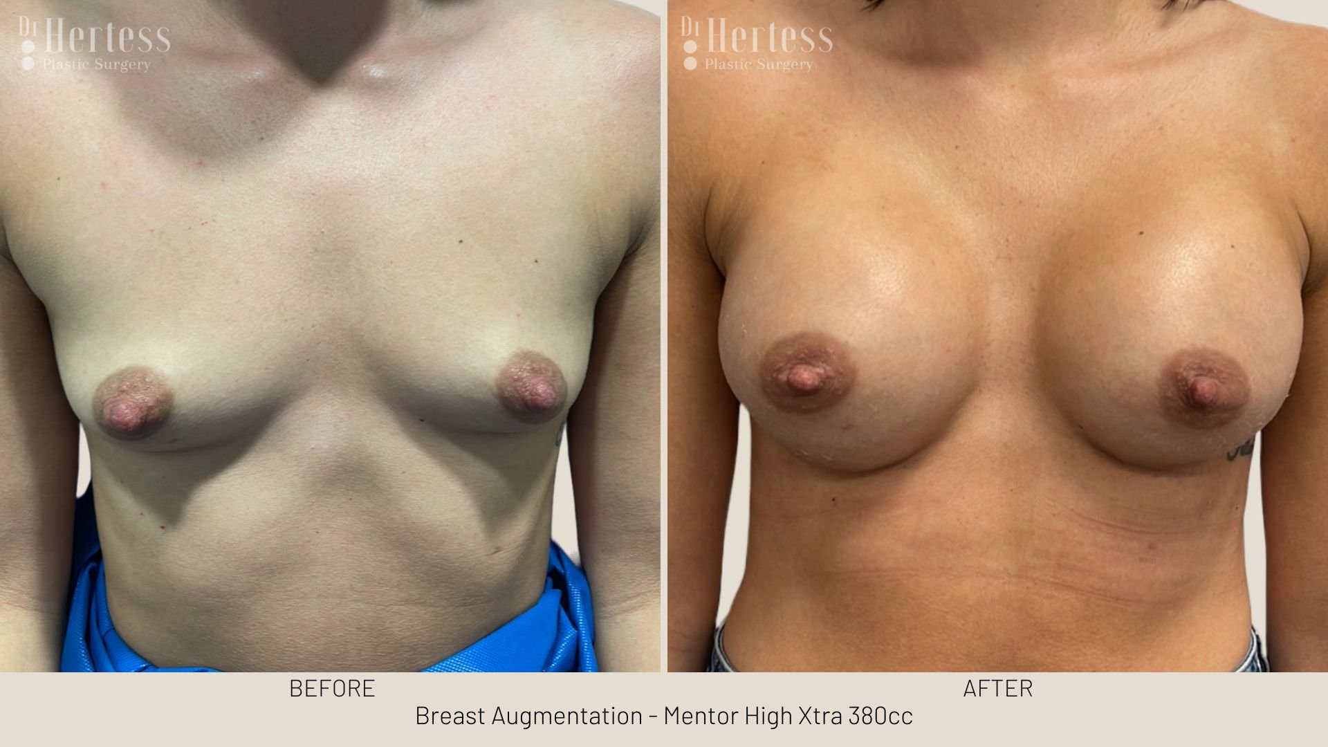 boob job before and after