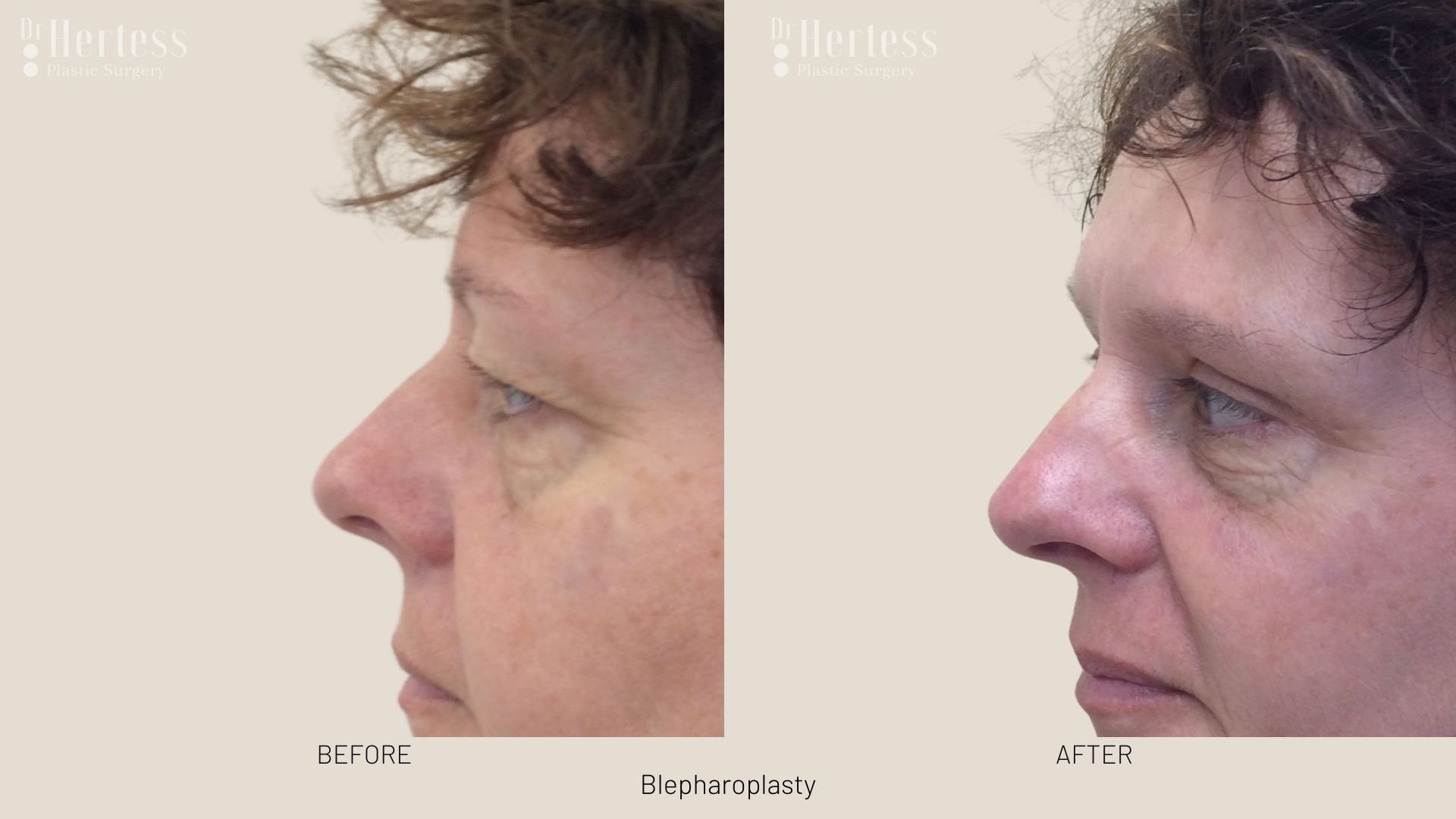 blepharoplasty surgery before and after