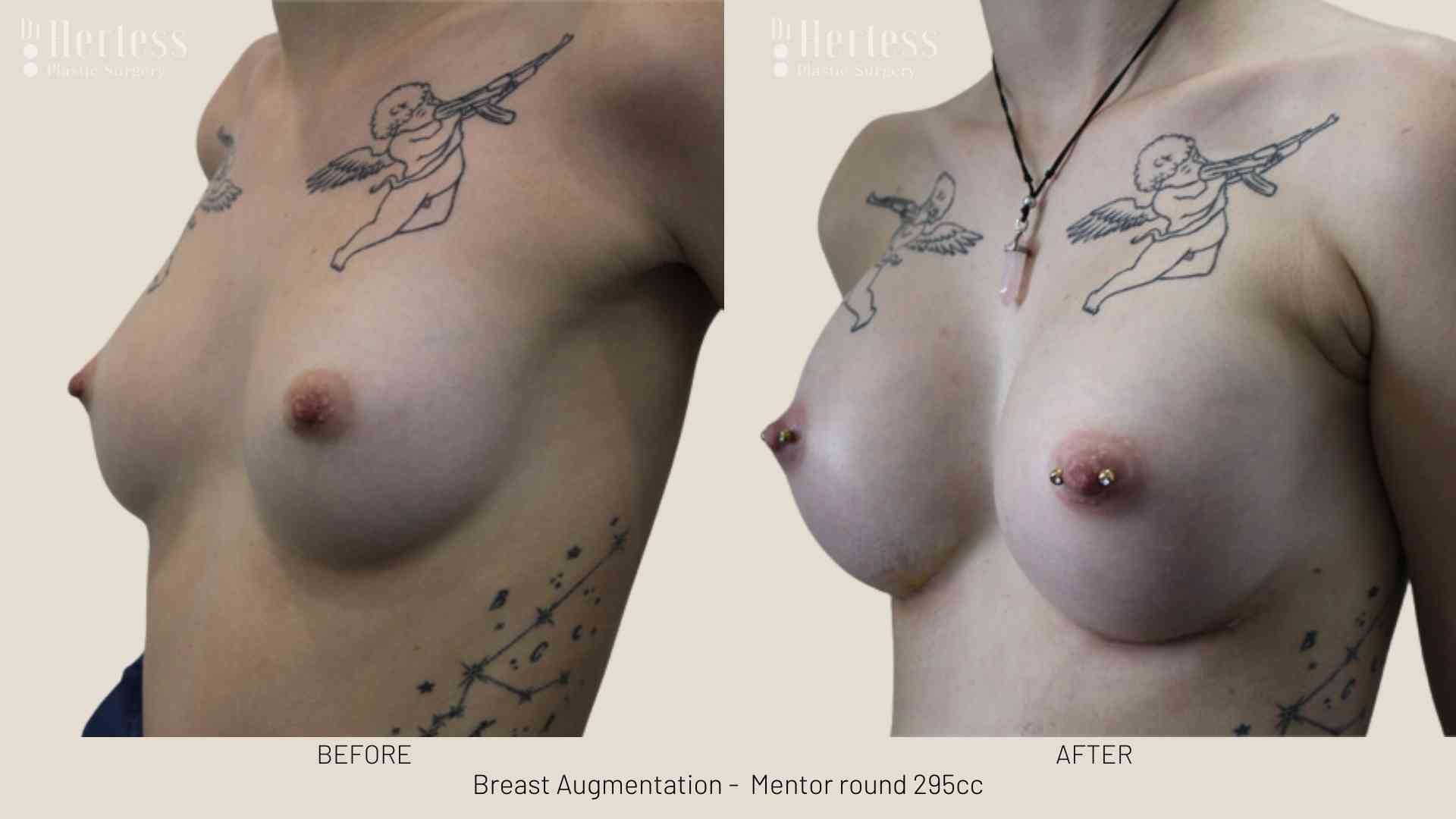 breast implant pics 