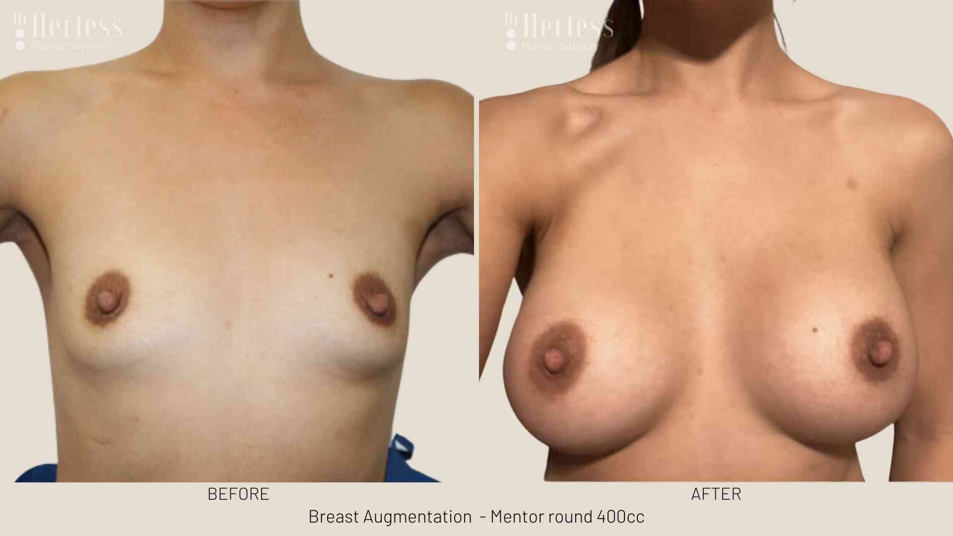 breast implants before and after photos