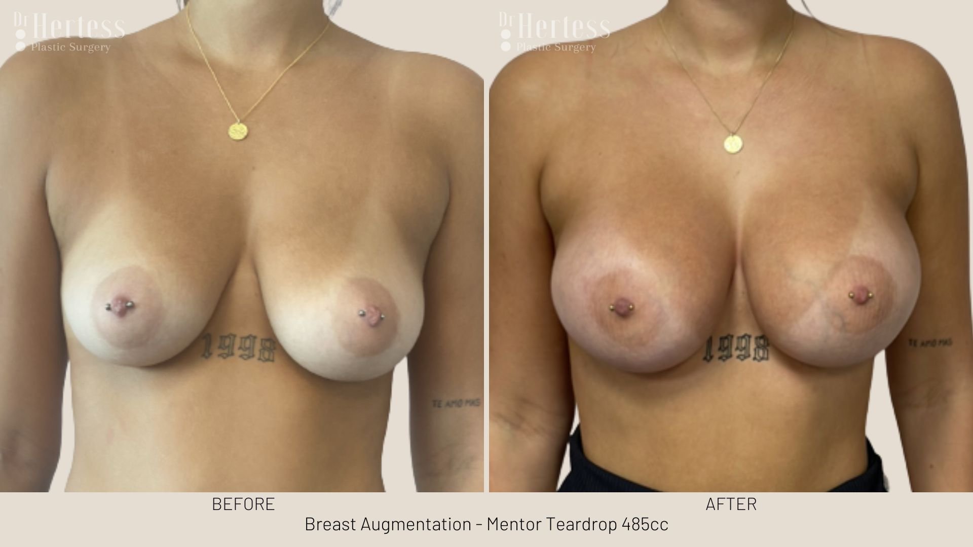 boob job before and after