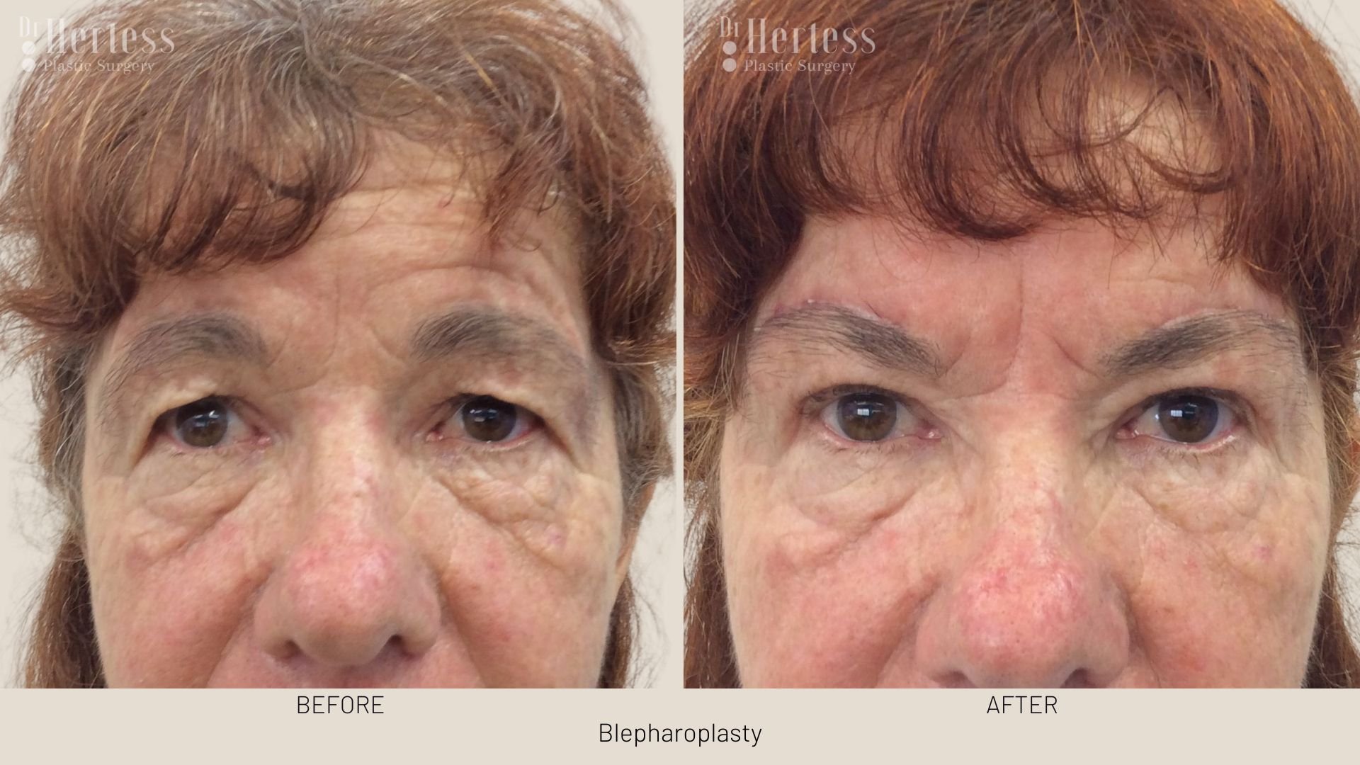 blepharoplasty surgery before and after