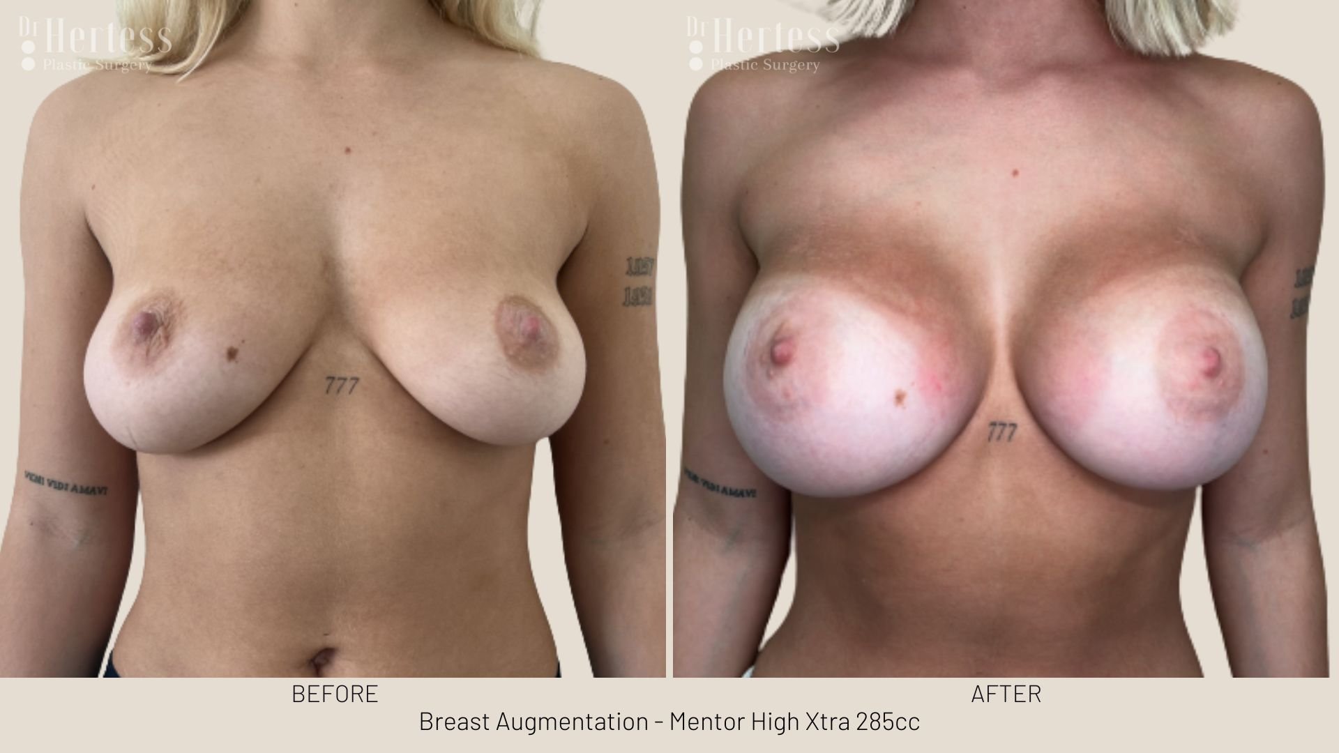 boob job before and after